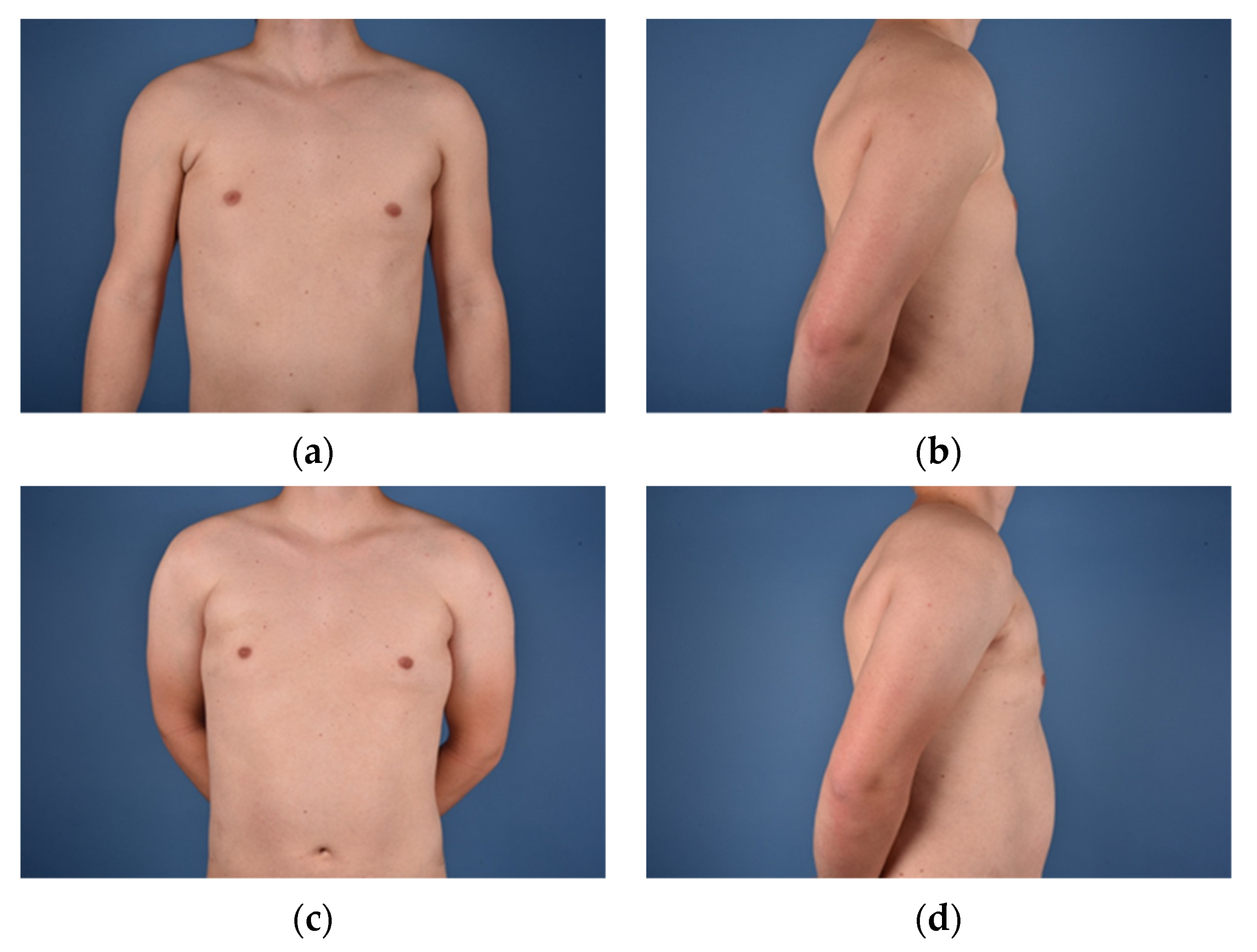 JCM Free Full-Text Development of A Surgical Treatment Algorithm for Breast Reconstruction in Poland Syndrome Patients Considering Severity, Sex, and photo photo