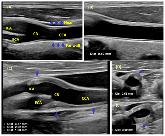 Clinical Significance of Carotid Intima-Media Complex and Carotid Plaque Assessment by Ultrasound for the Prediction of Adverse... 