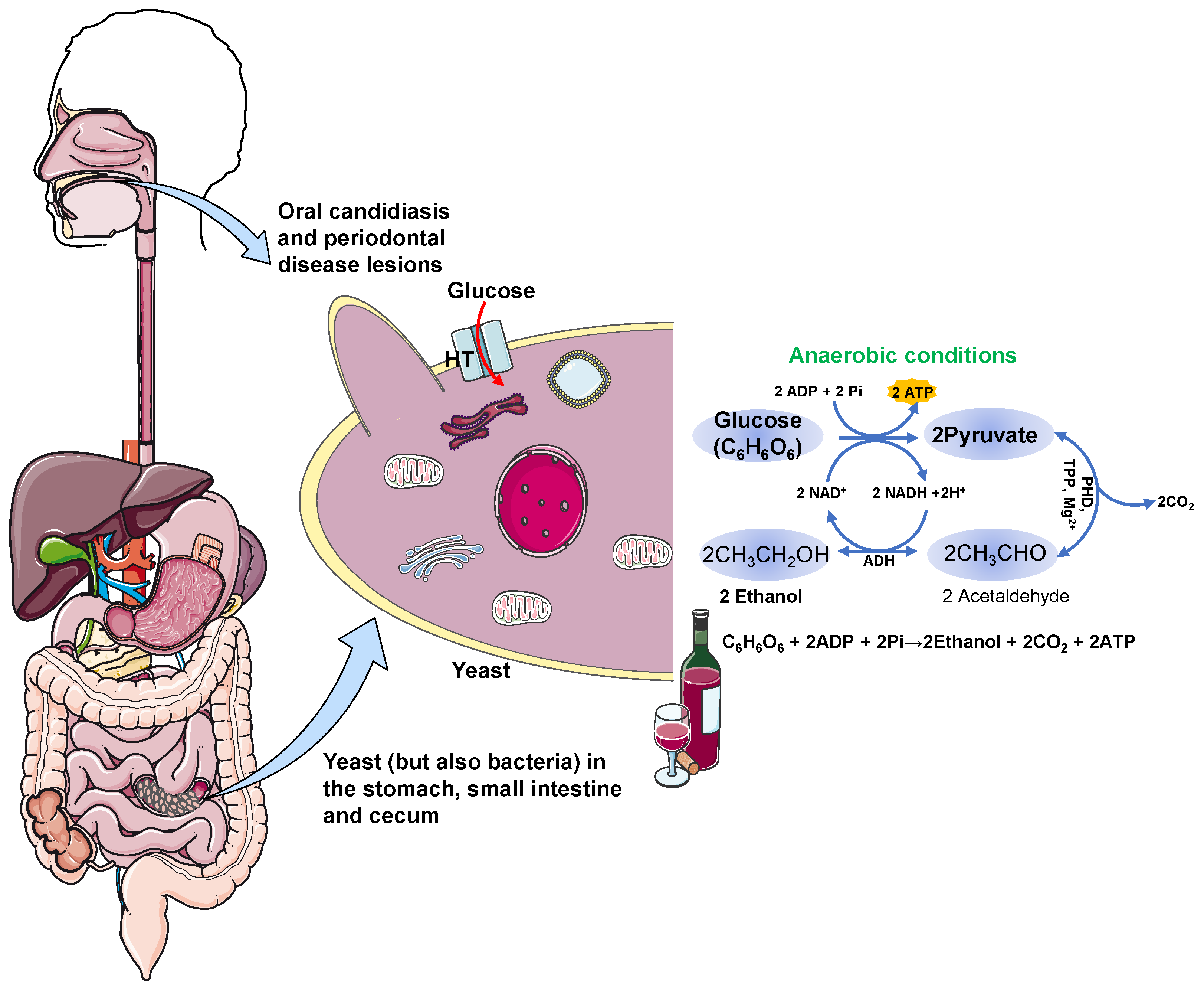 JCM Free FullText The AutoBrewery Syndrome A Perfect Metabolic