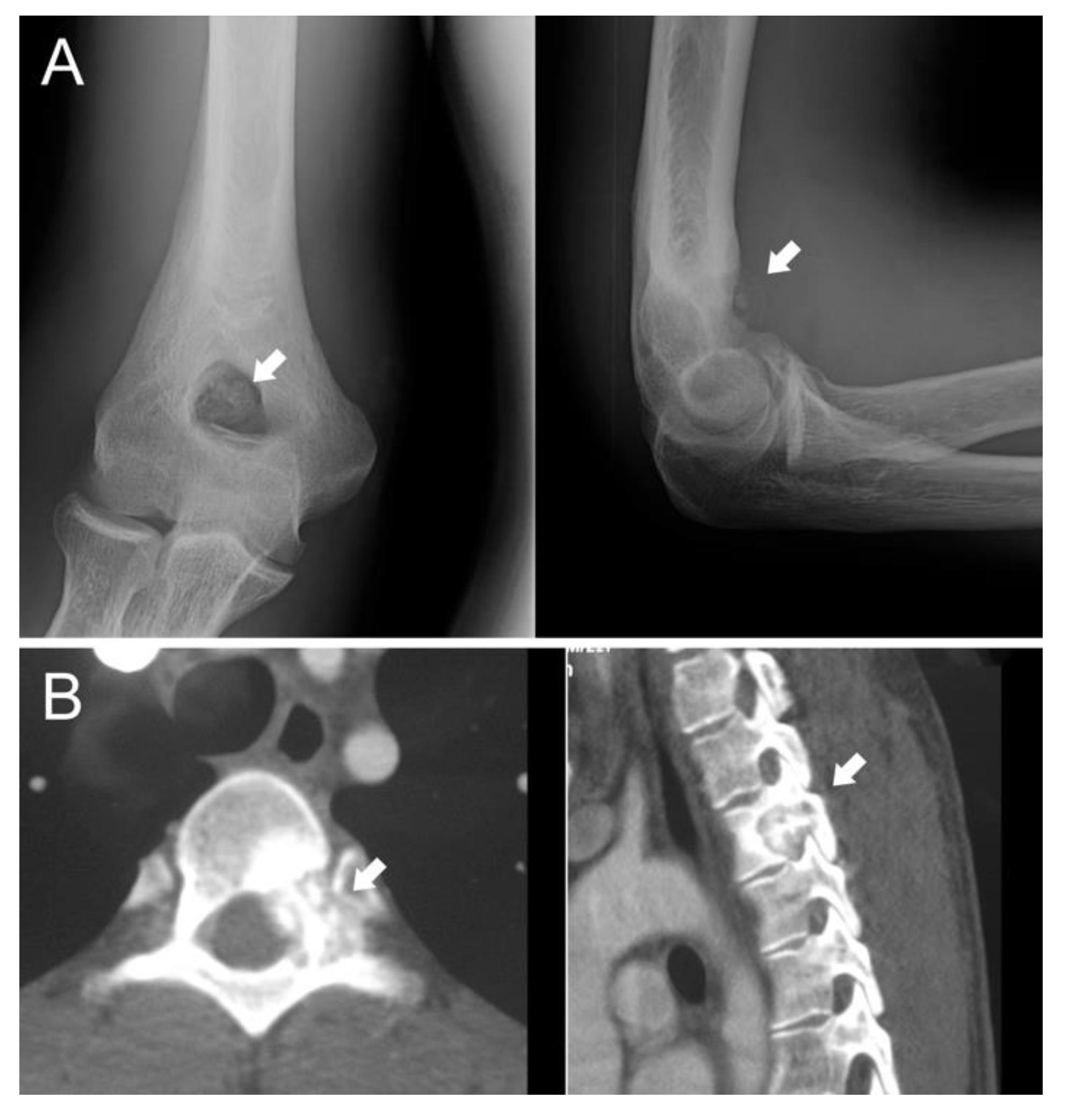JCM | Free Full-Text | Osteoblastoma: When the Treatment Is Not Minimally  Invasive, an Overview