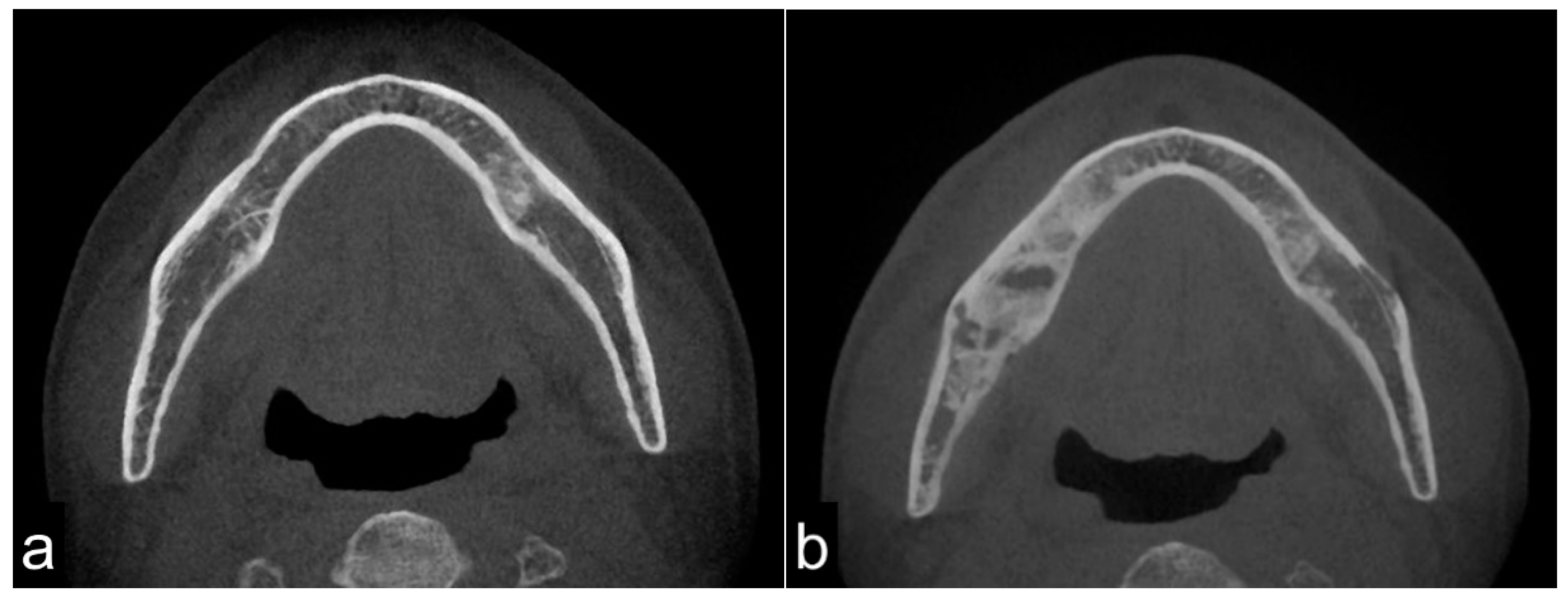 Key Considerations when Treating a Collapsed Jaw