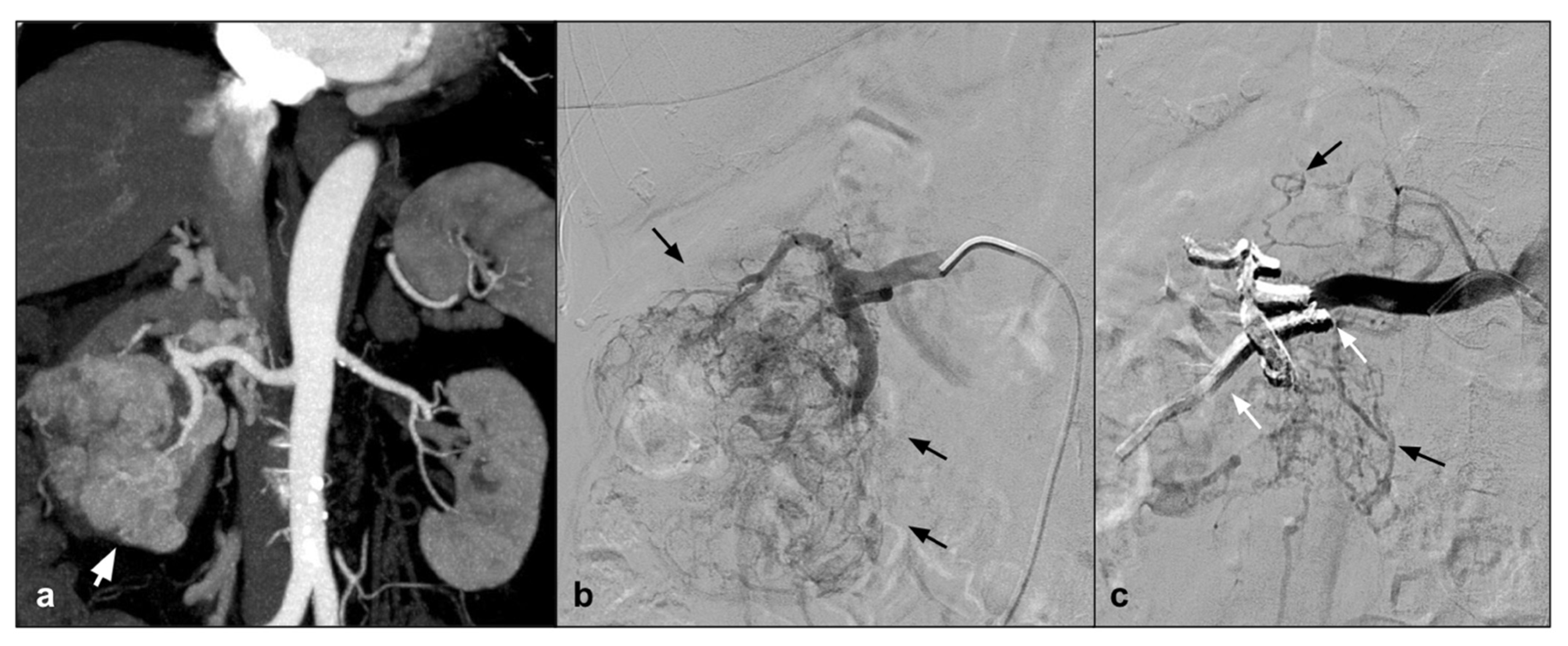 Glue, Onyx, Squid or PHIL? Liquid Embolic Agents for the Embolization of  Cerebral Arteriovenous Malformations and Dural Arteriovenous Fistulas