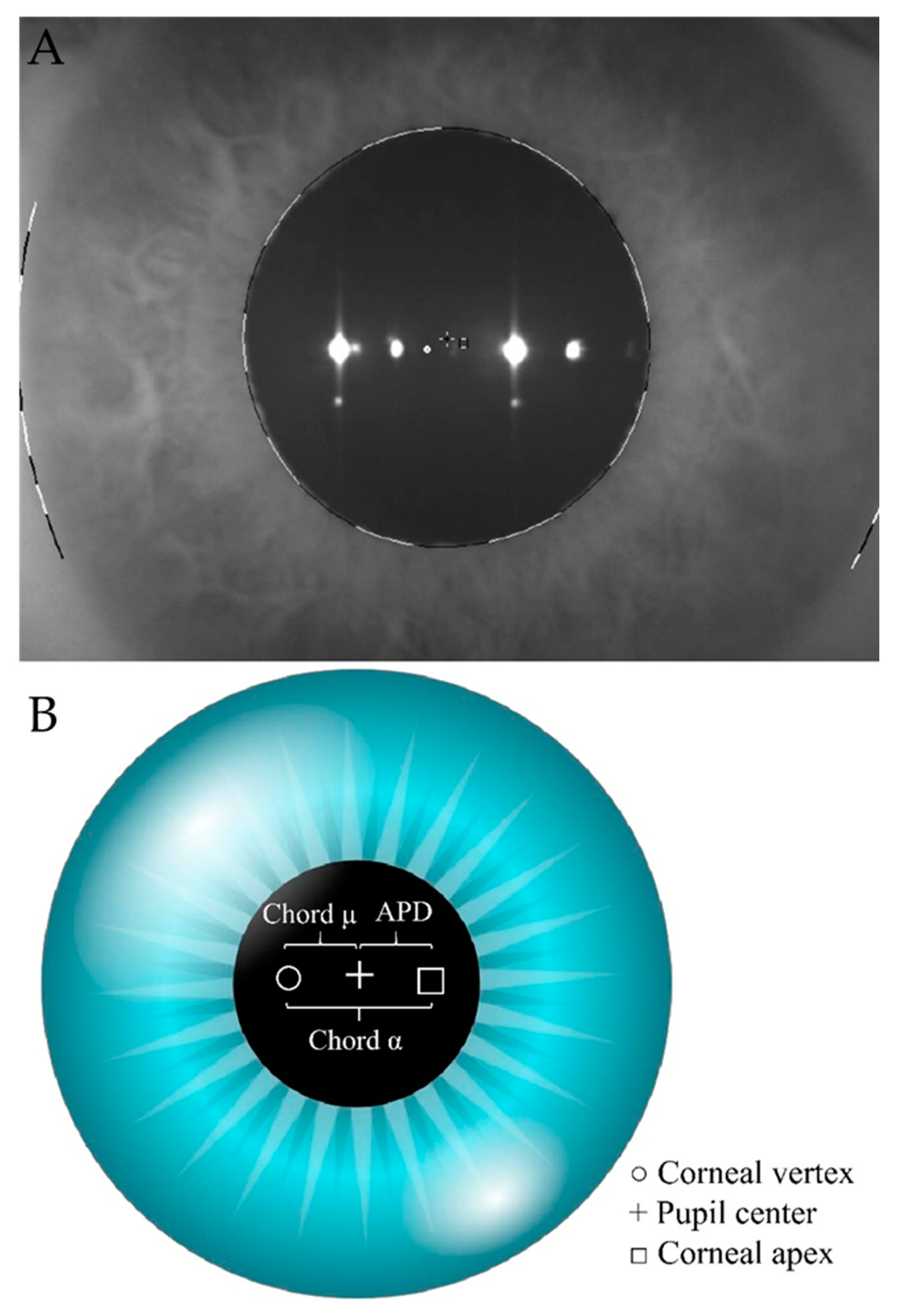 Jcm Free Full Text Chord Mu µ And Chord Alpha A Length Changes In Fuchs Endothelial Corneal Dystrophy Before And After Descemet Membrane Endothelial Keratoplasty Dmek Surgery Html Jcm Free Full Text Chord Mu µ And Chord Alpha A Length Changes In Fuchs Endothelial Corneal Dystrophy Before And After Descemet Membrane Endothelial Keratoplasty Dmek Surgery Html