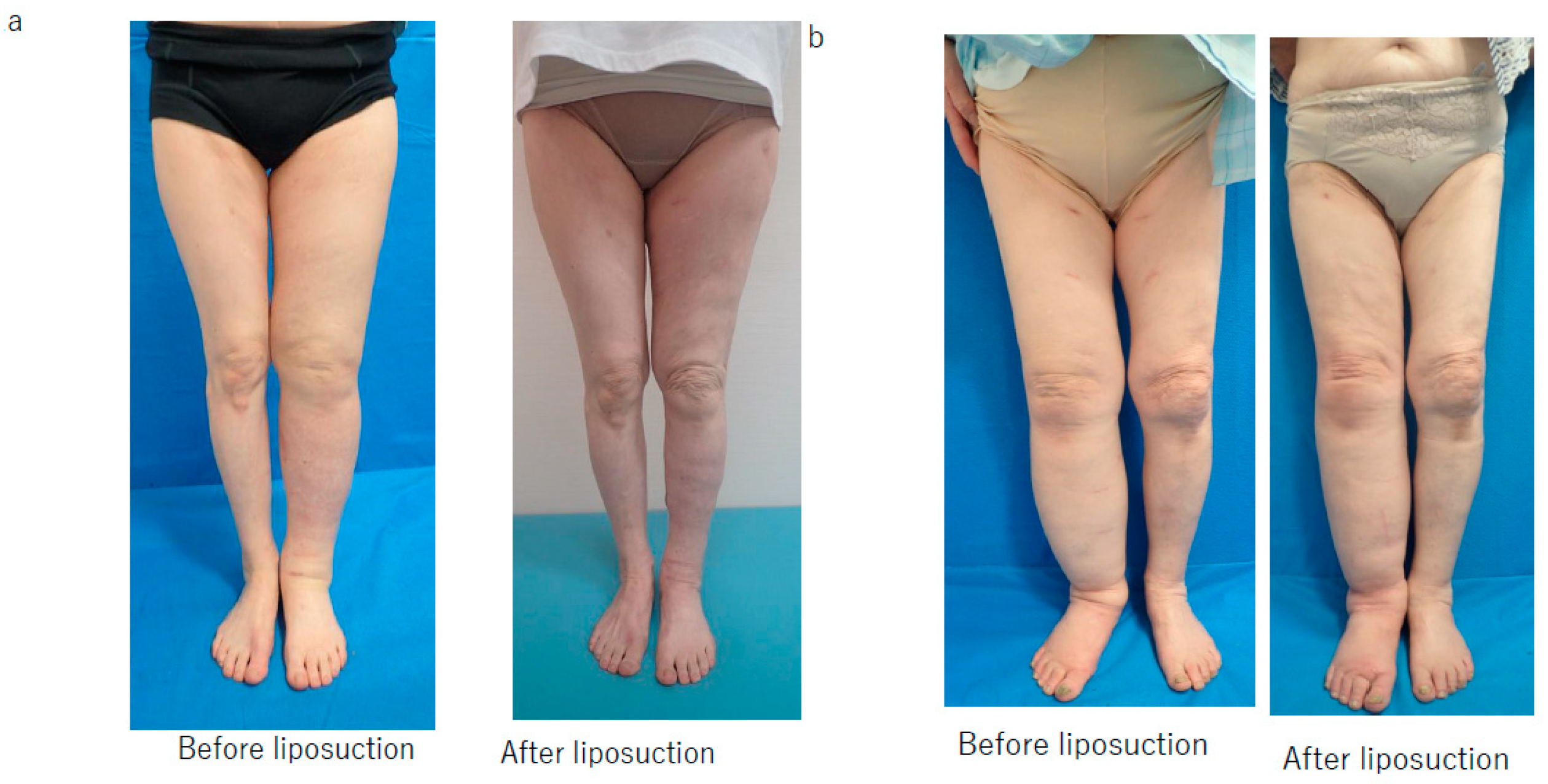 Requirement Of Compression Garments After Liposuction