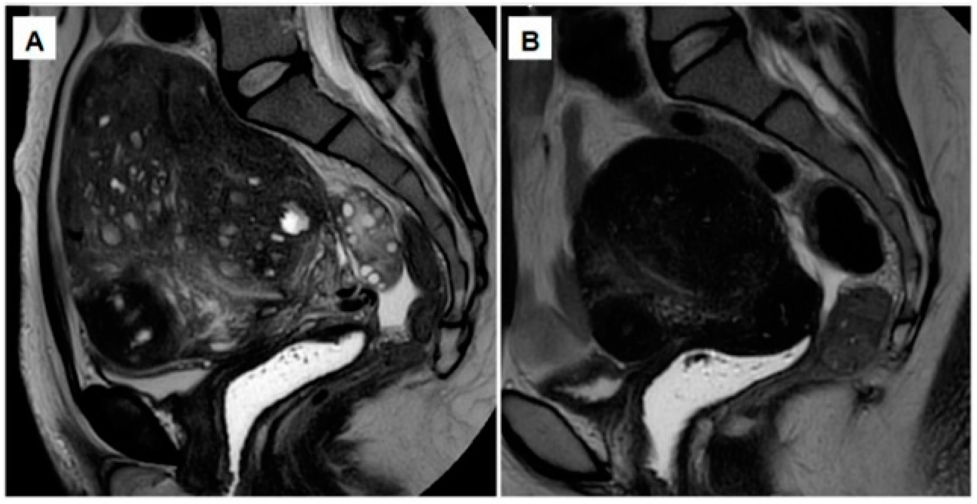JCM Free FullText Conservative Management of Uterine Adenomyosis Medical vs. Surgical Approach