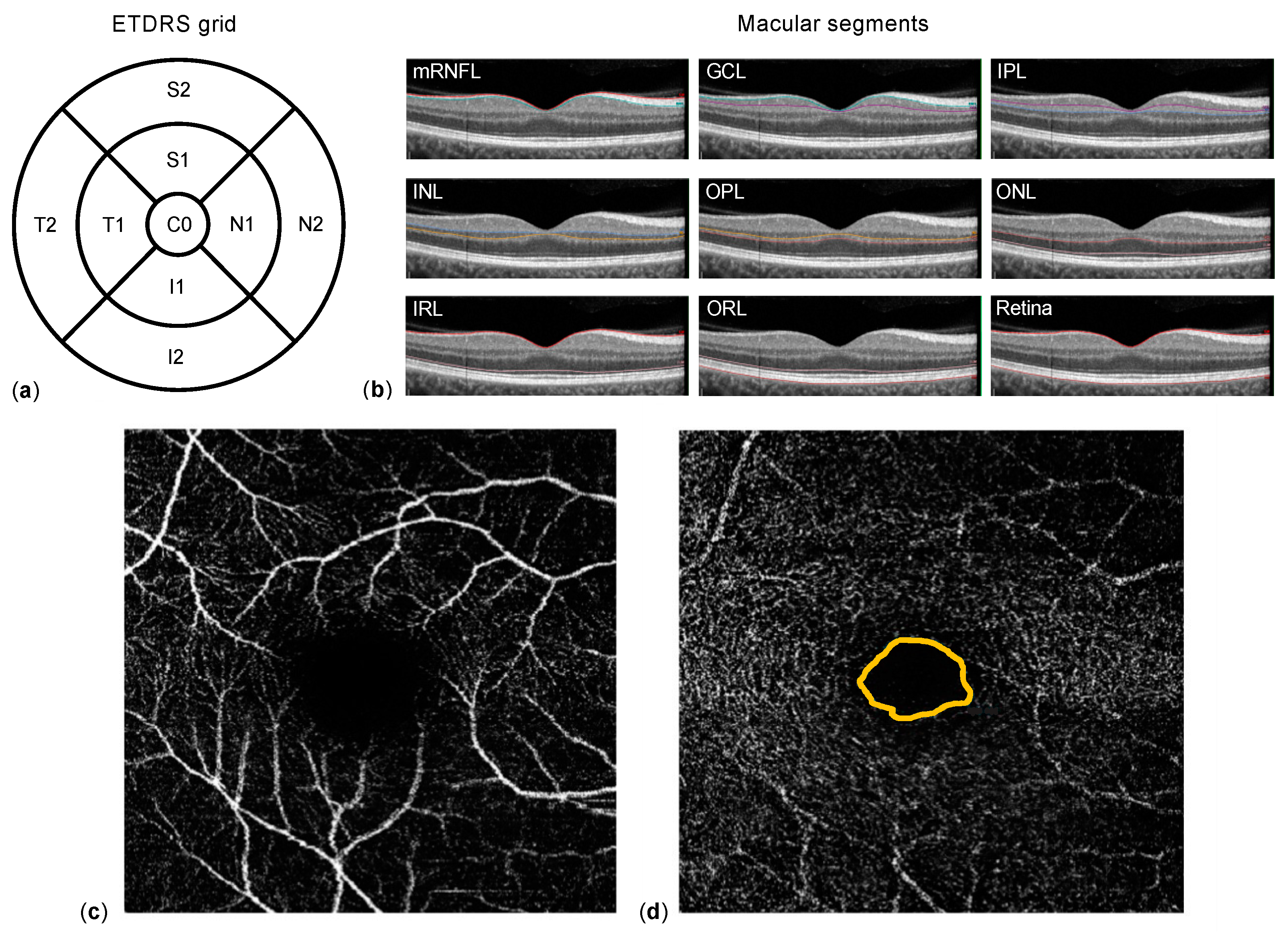 Altered ocular microvasculature in patients with systemic sclerosis and  very early disease of systemic sclerosis using optical coherence tomography  angiography