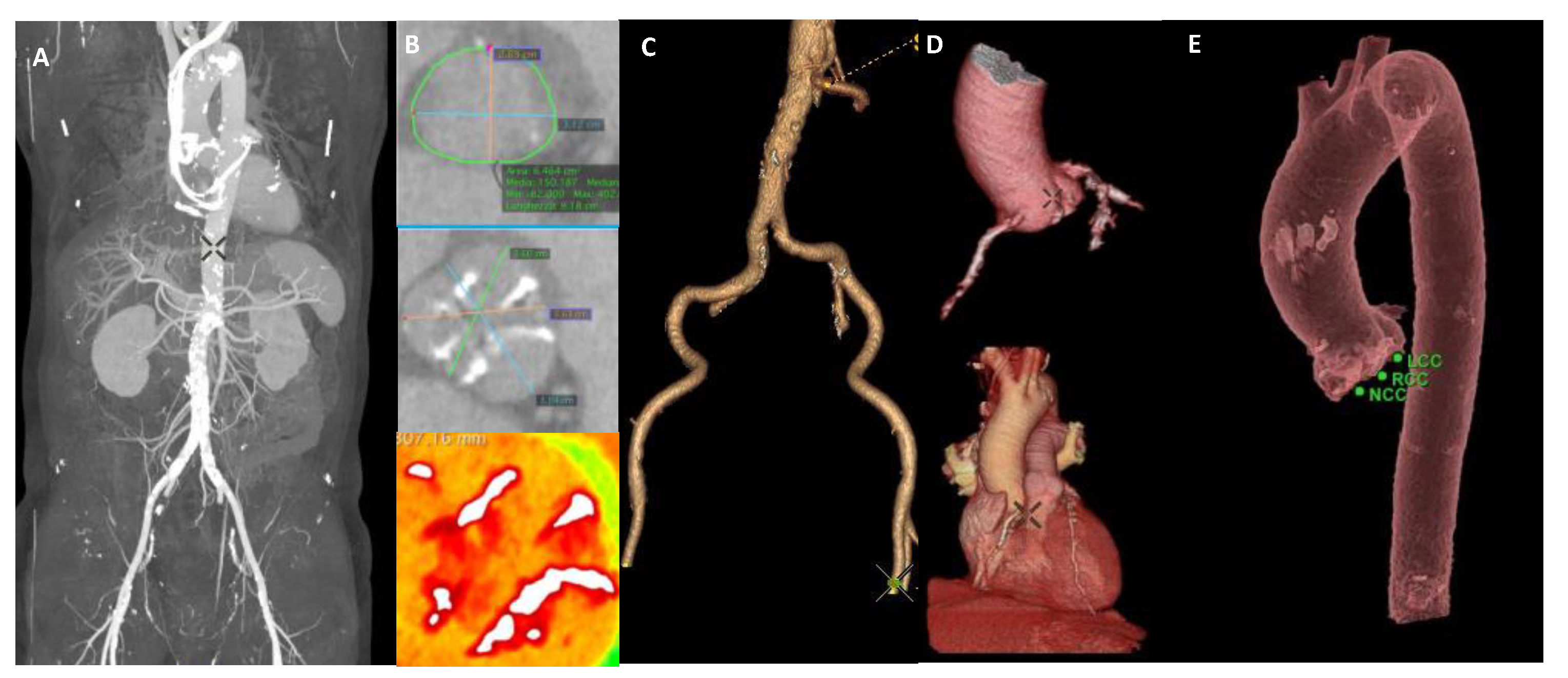 JCM   Free Full Text   Diagnostic Work Up of the Aortic Patient ...