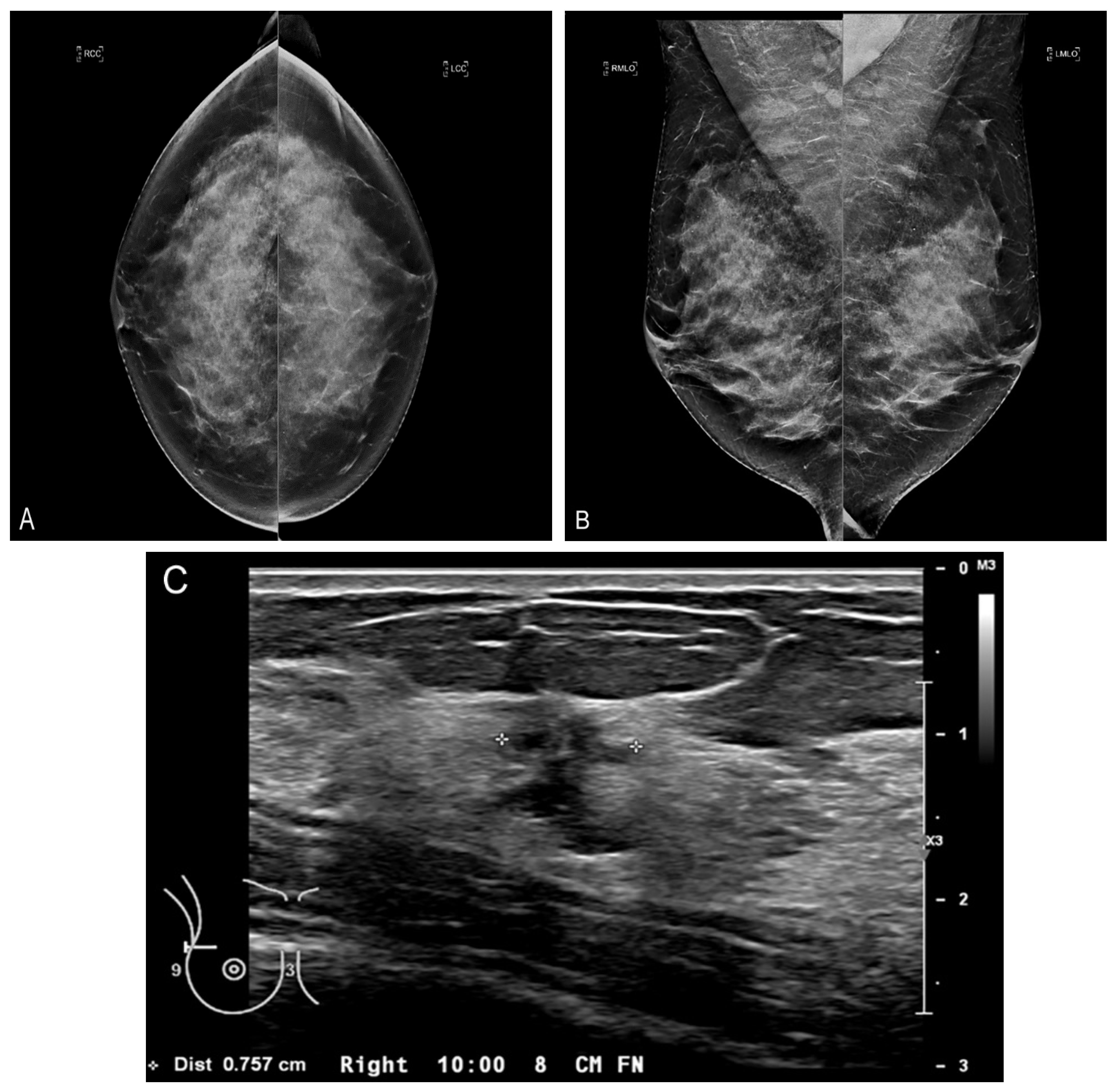Breast Ultrasonography: Practice Essentials, Technique, Invasive  Ultrasonography
