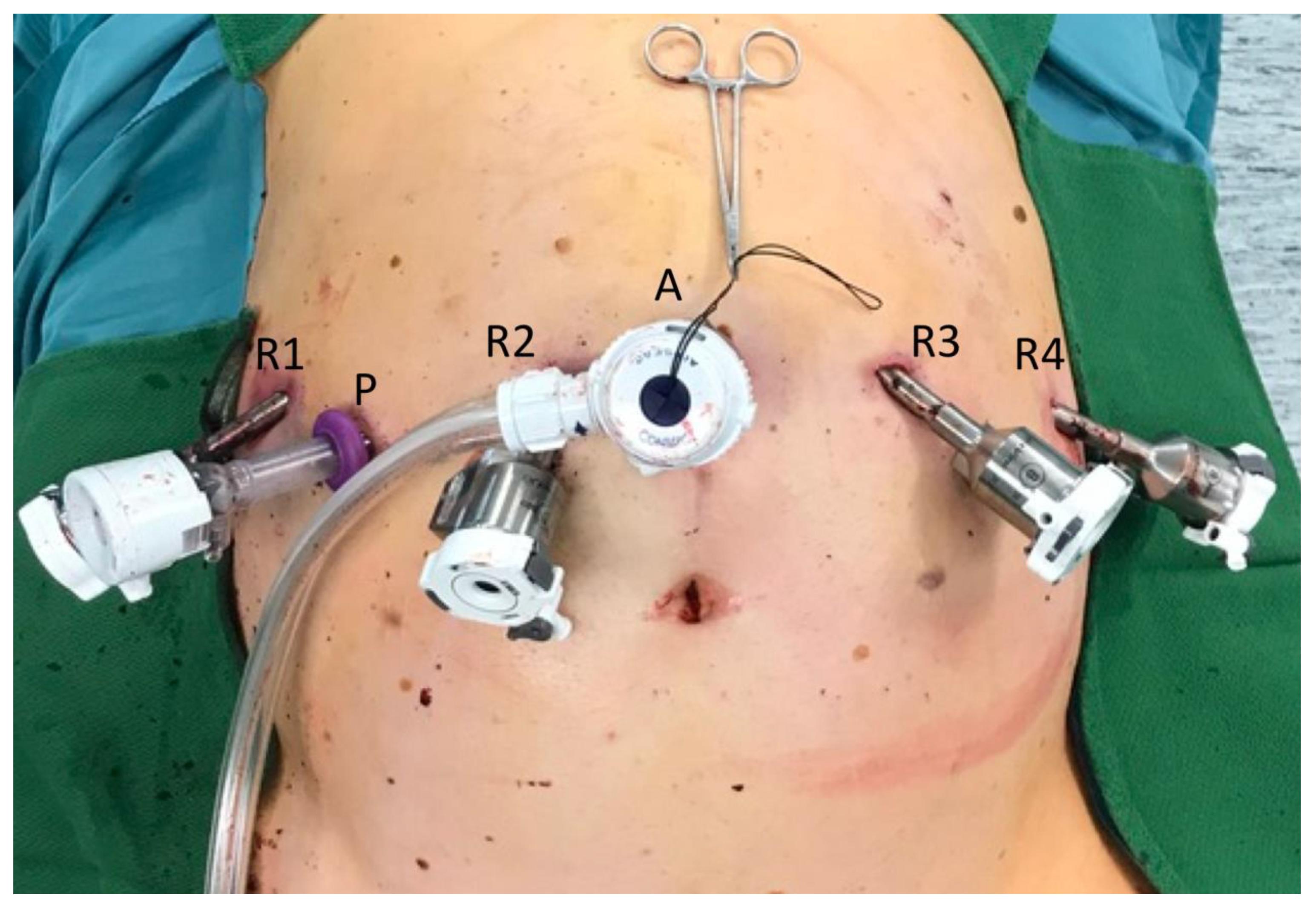 Marty Fielding línea Edición JCM | Free Full-Text | Three-Device (3D) Technique for Liver Parenchyma  Dissection in Robotic Liver Surgery