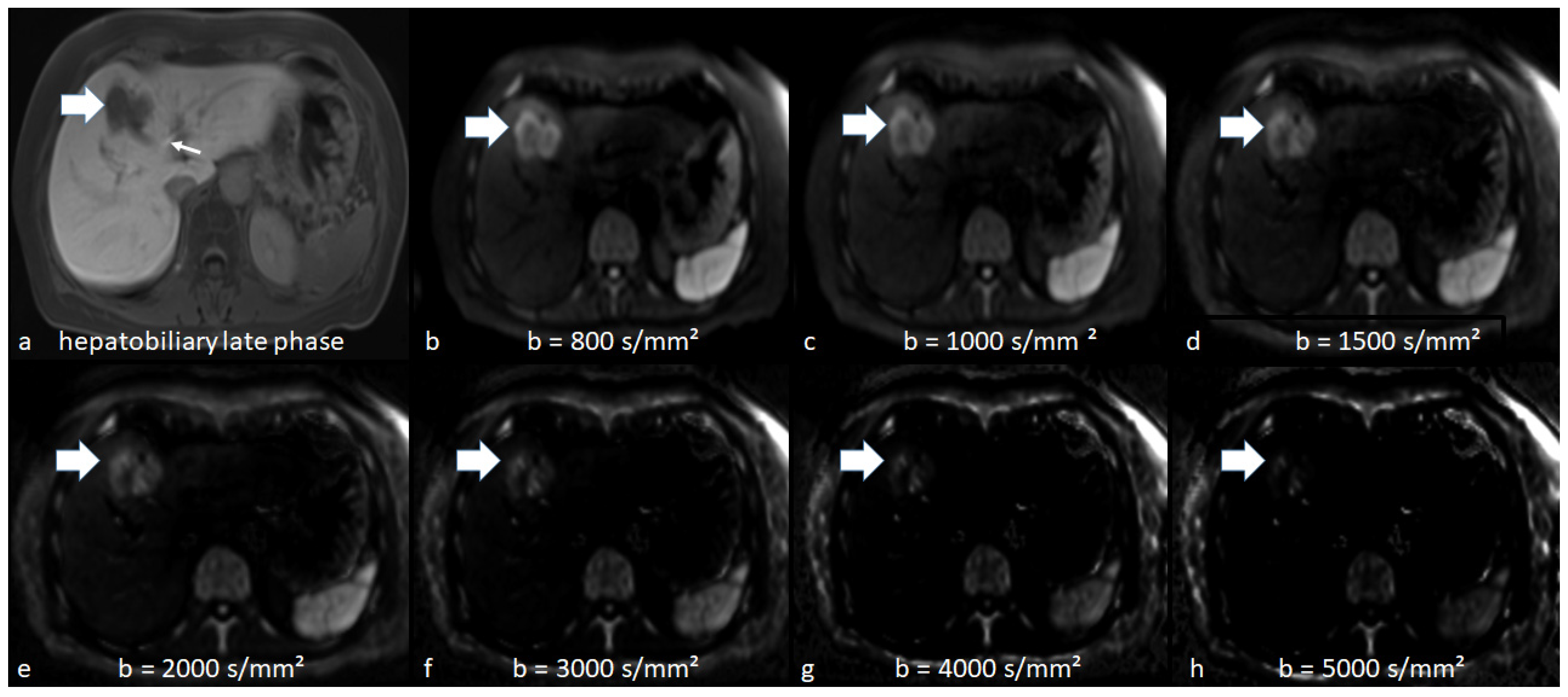 ADC values (mm2/s) of tumor and liver at different time points.