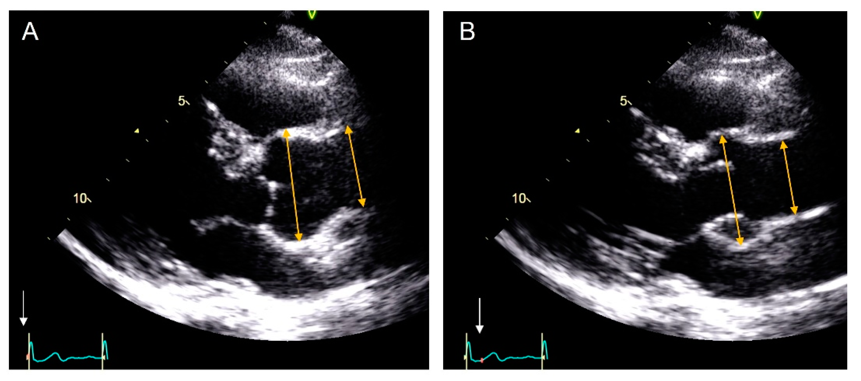 Thoracic aortic aneurysm echocardiogram
