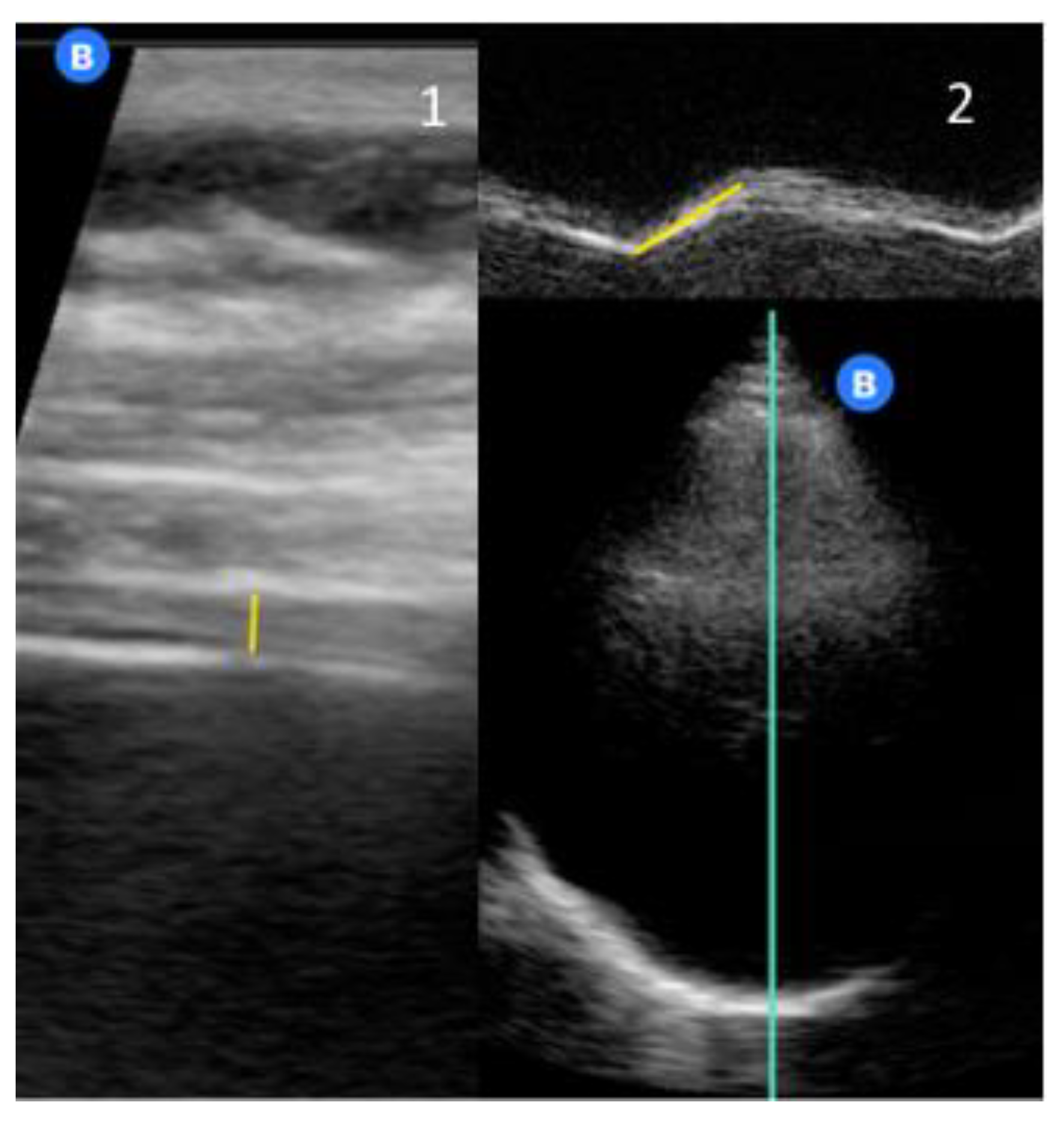 JCM Free FullText Diaphragmatic PointofCare Ultrasound in COVID