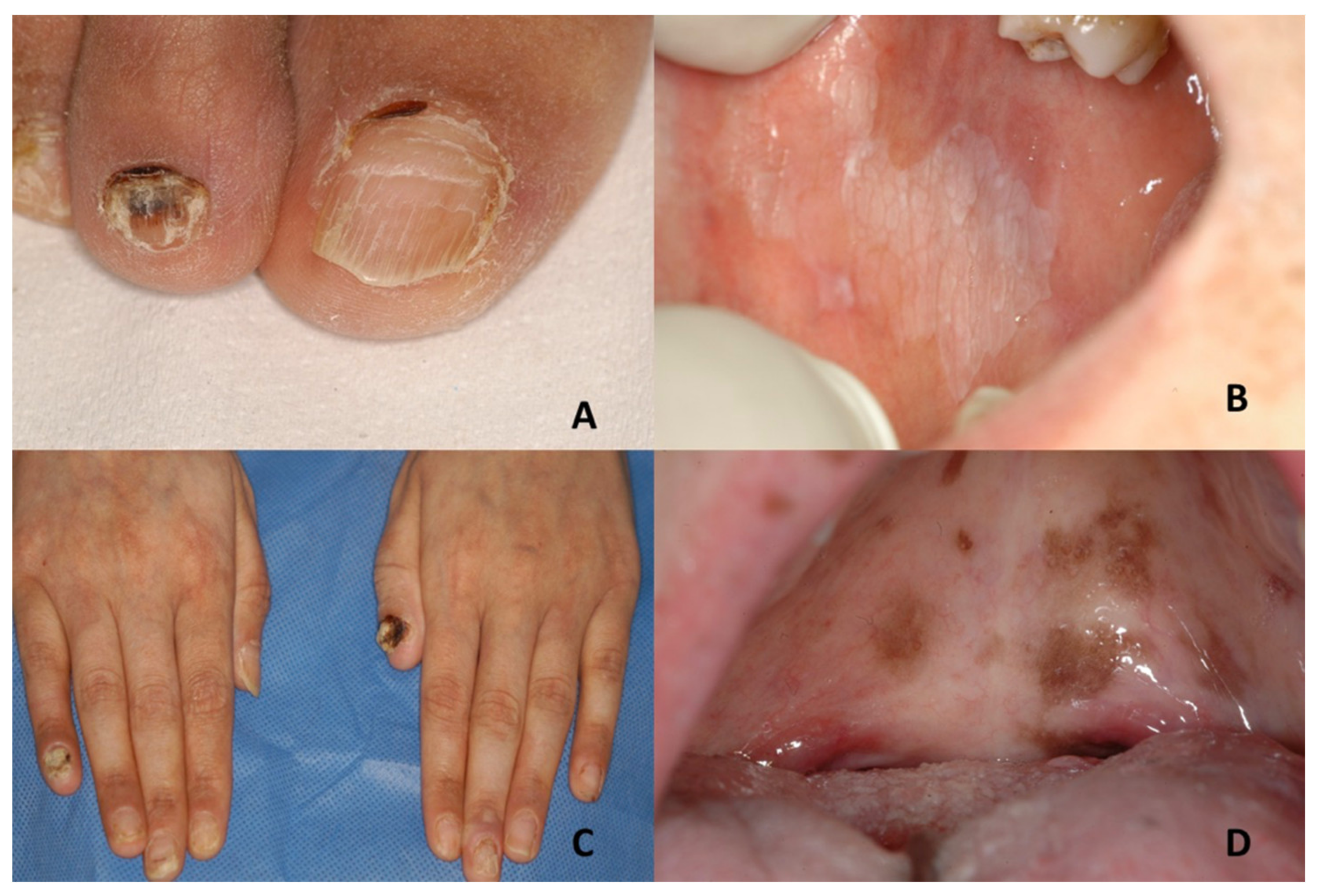 PDF] Peripheral cemento-ossifying fibroma associated with TUBEROUS SCLEROSIS  | Semantic Scholar