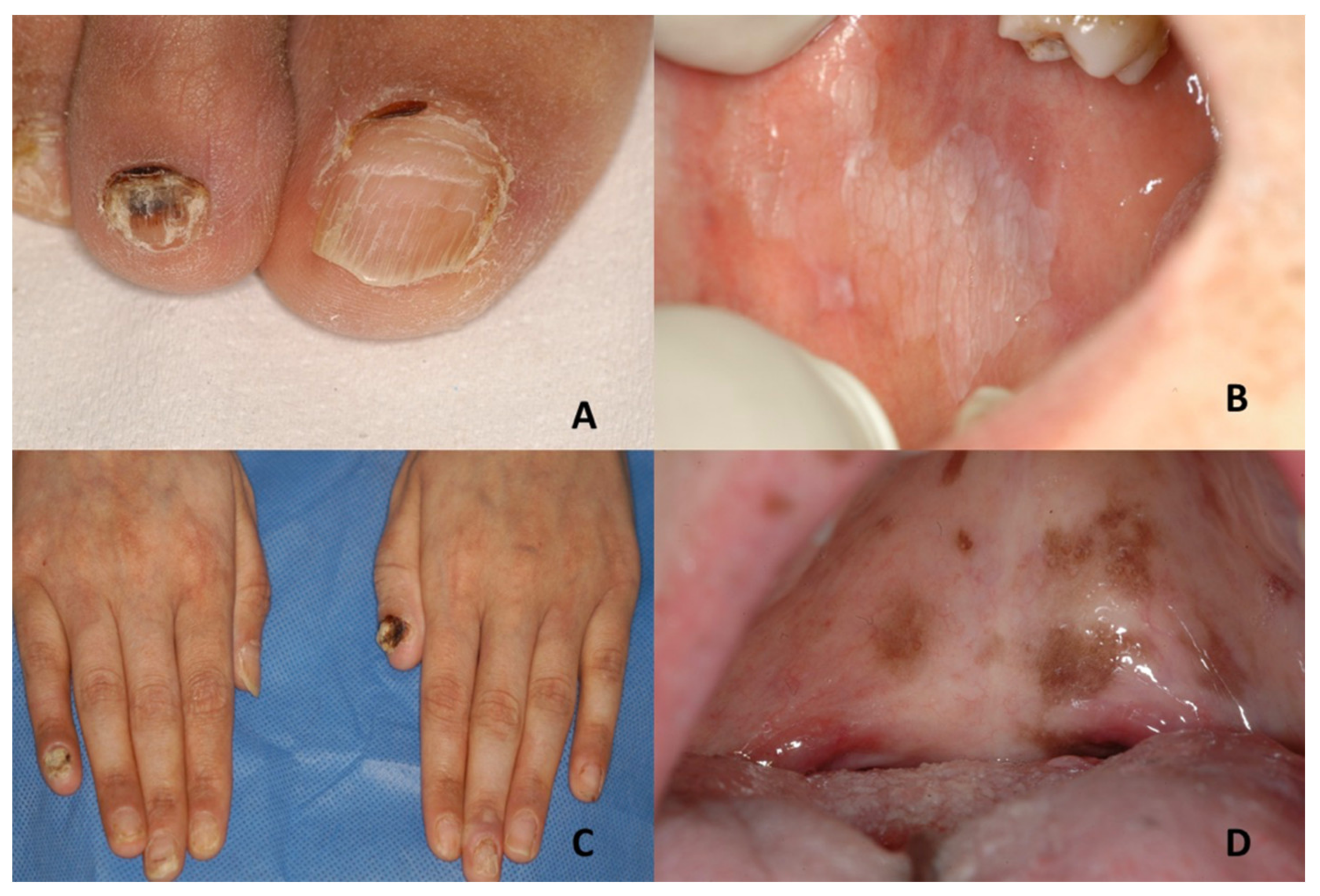 Rubinstein-Taybi Syndrome: A Complete Overview — DermNet