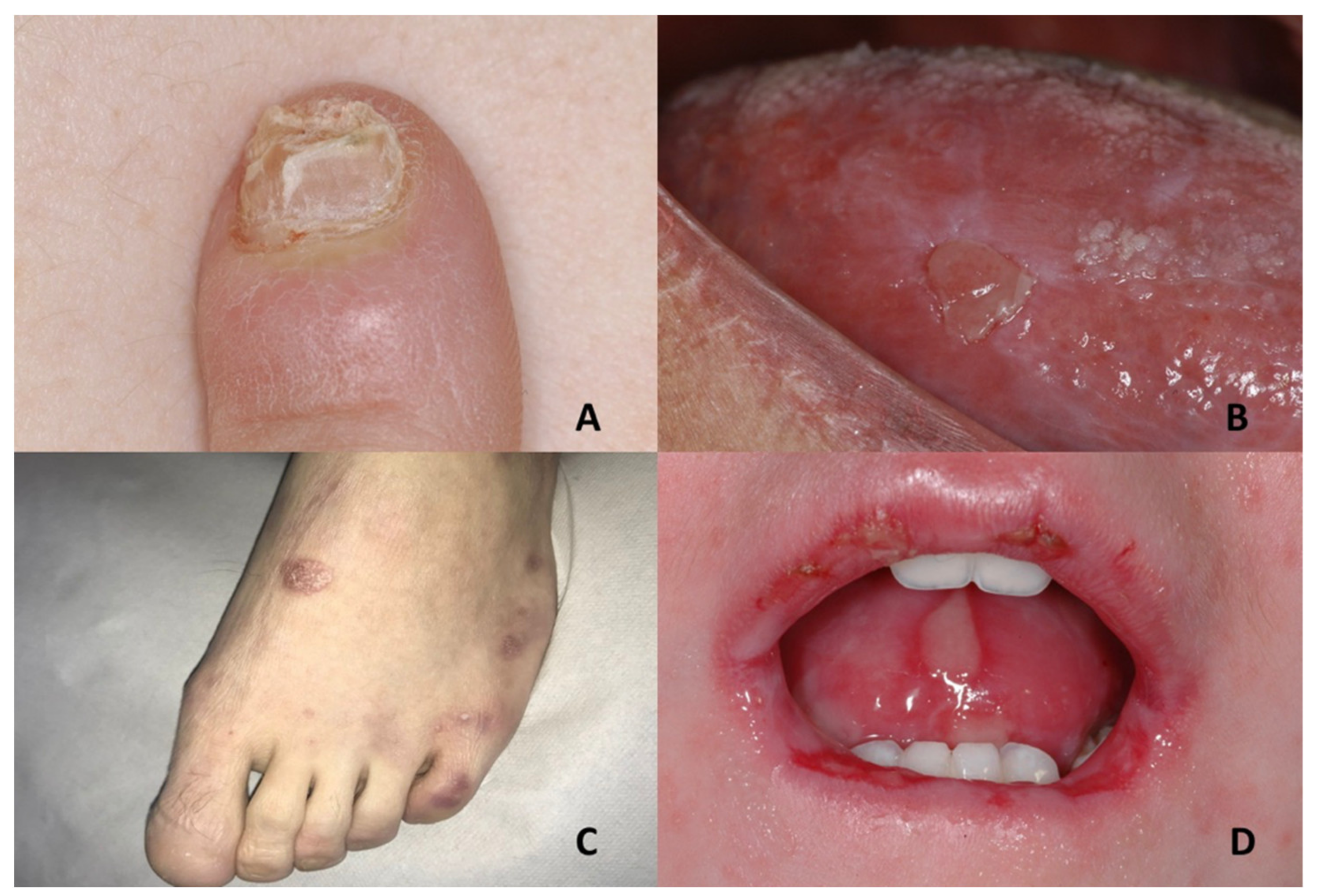 Translated article] Frontal Examination of the Distal Nail Unit | Actas  Dermo-Sifiliográficas