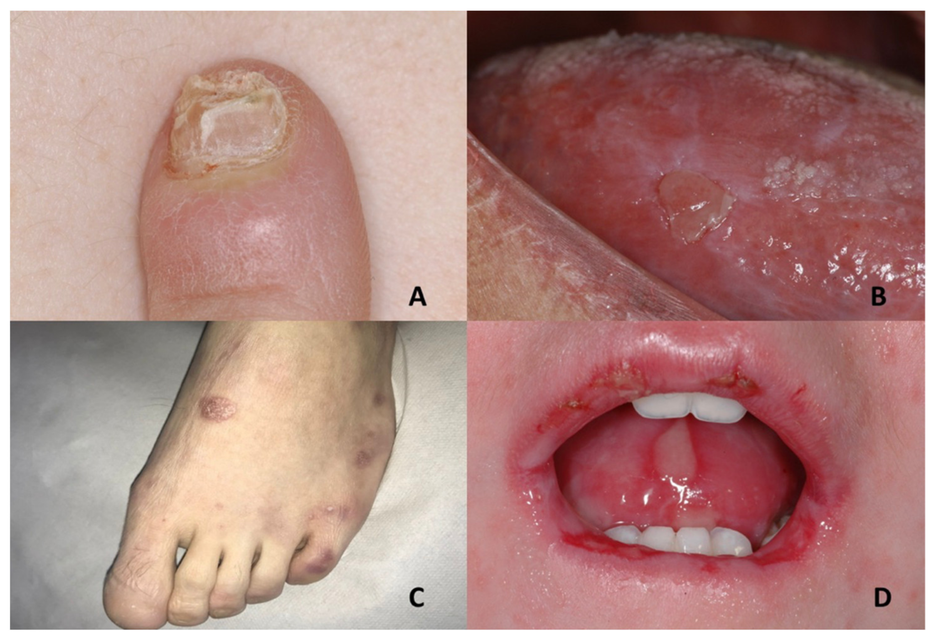 Rubinstein-Taybi Syndrome Images — DermNet