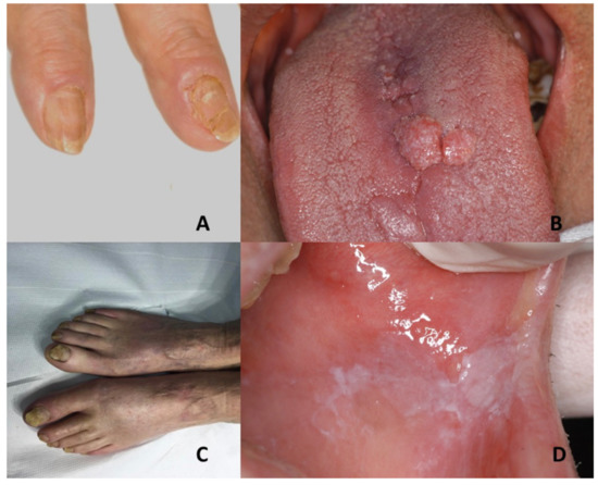 Rubinstein-Taybi Syndrome Images — DermNet