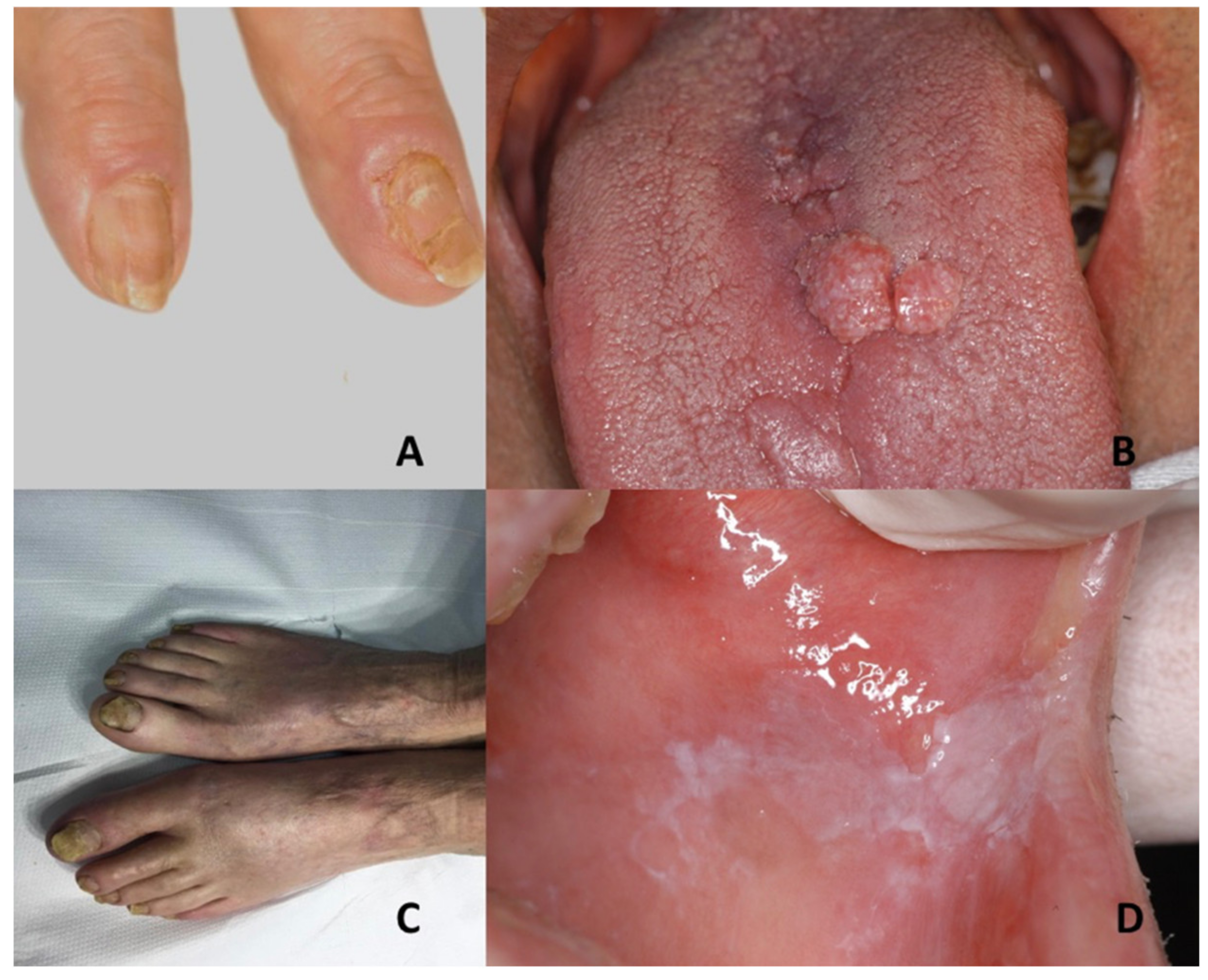 Rubinstein-Taybi Syndrome: A Complete Overview — DermNet