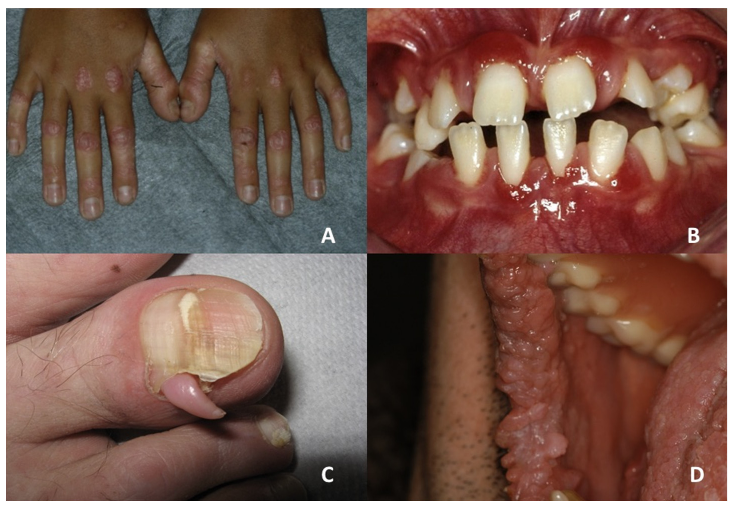 Rubinstein-Taybi Syndrome: A Complete Overview — DermNet