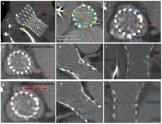 Jcm Free Full Text The Use Of Basilica Technique To Prevent Coronary Obstruction In A Tavi Tavi Procedure Html