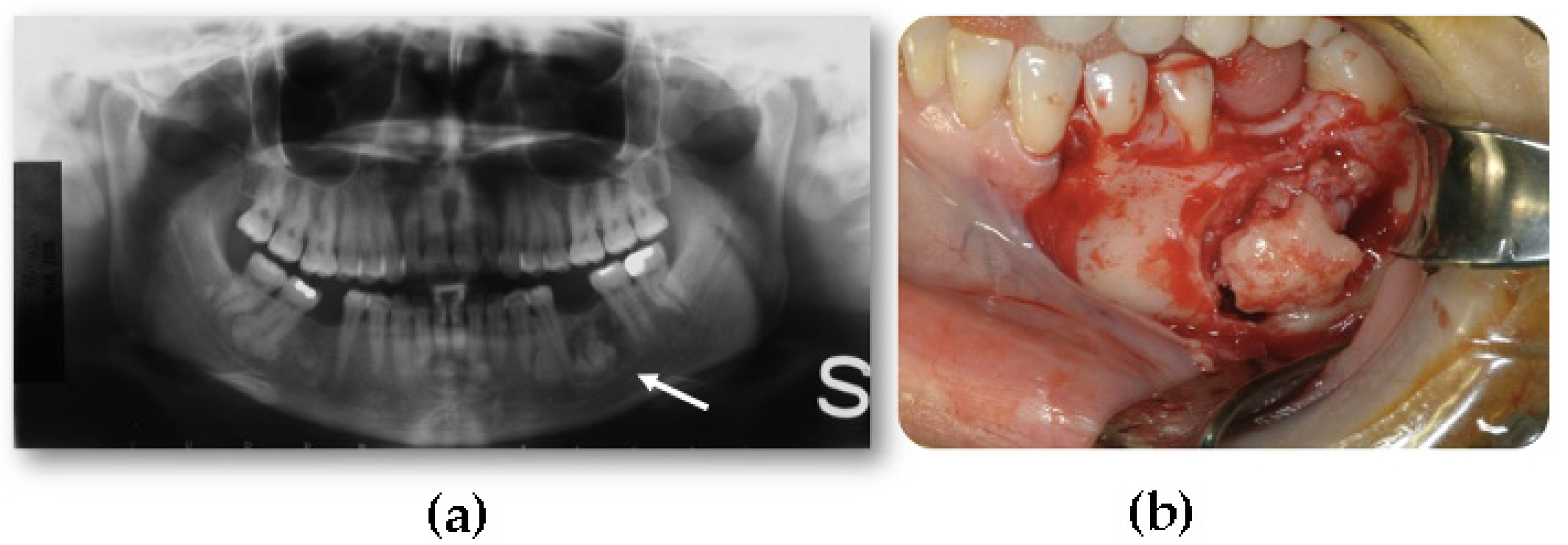 JCM Free FullText Craniofacial Osteomas From Diagnosis to Therapy