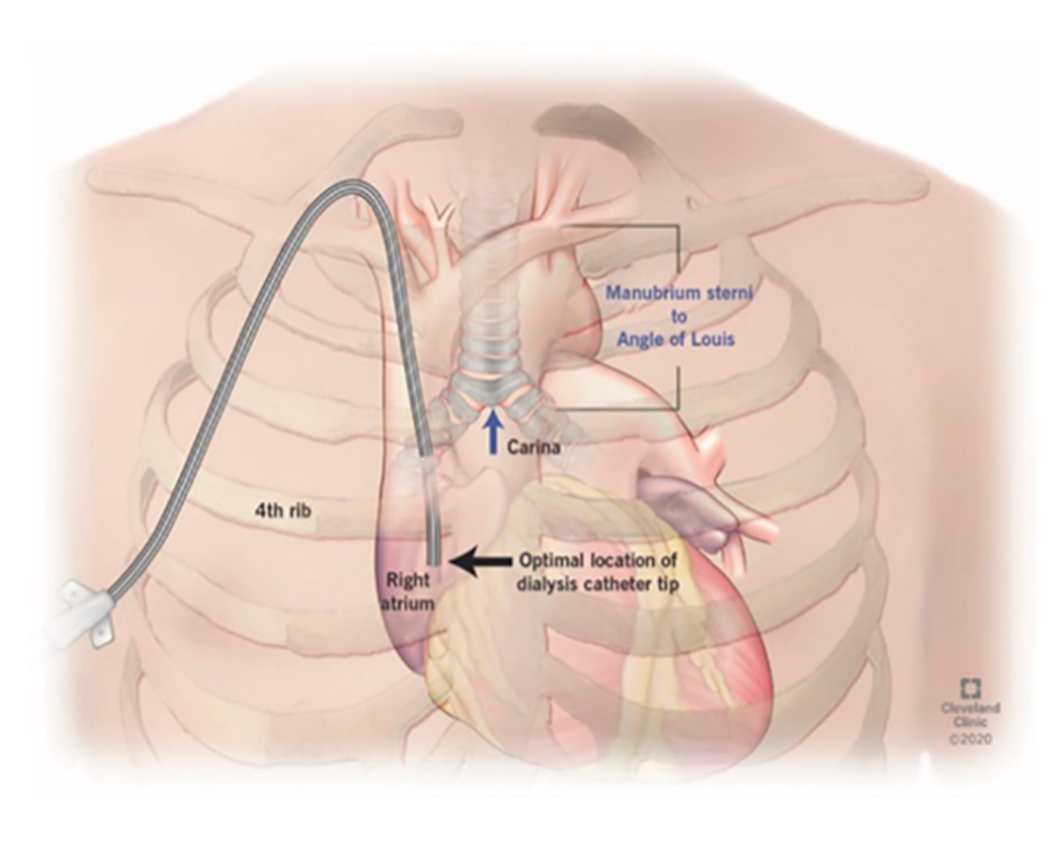 Dialysis Catheter Types