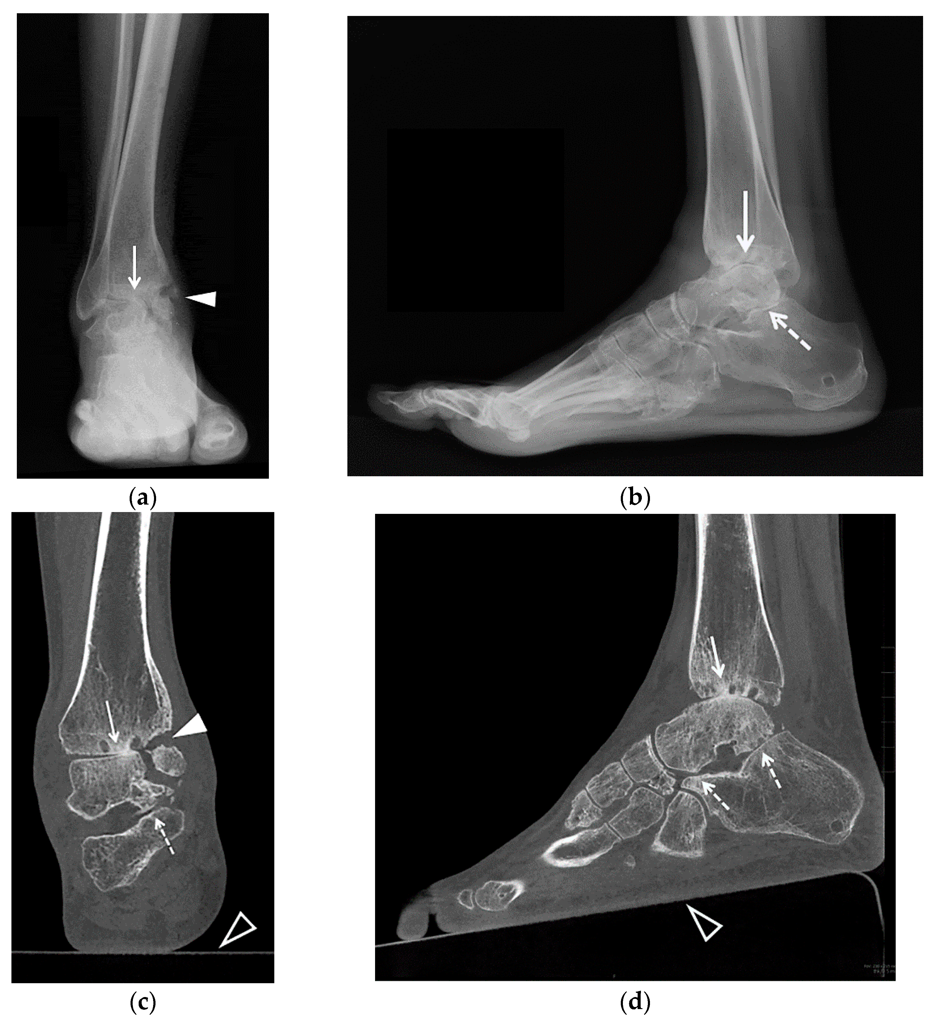 a calcaneus osteoarthritis)