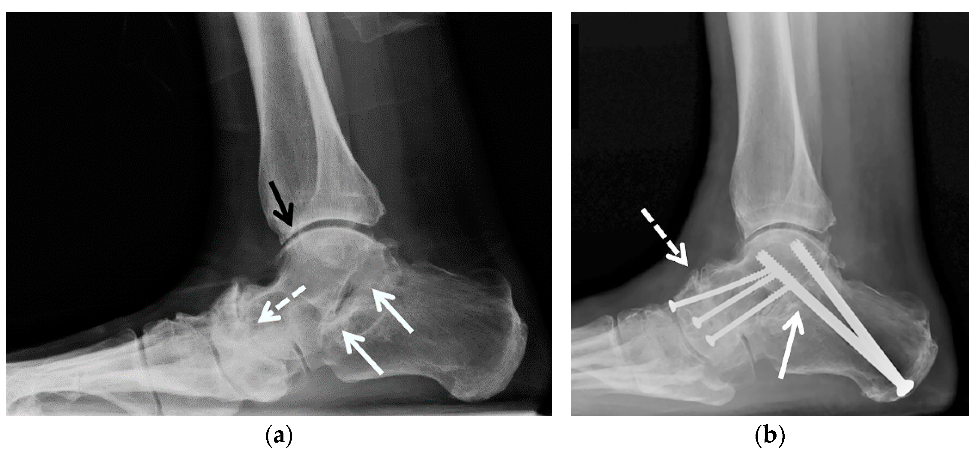 Hindfoot Arthrodesis | Musculoskeletal Key
