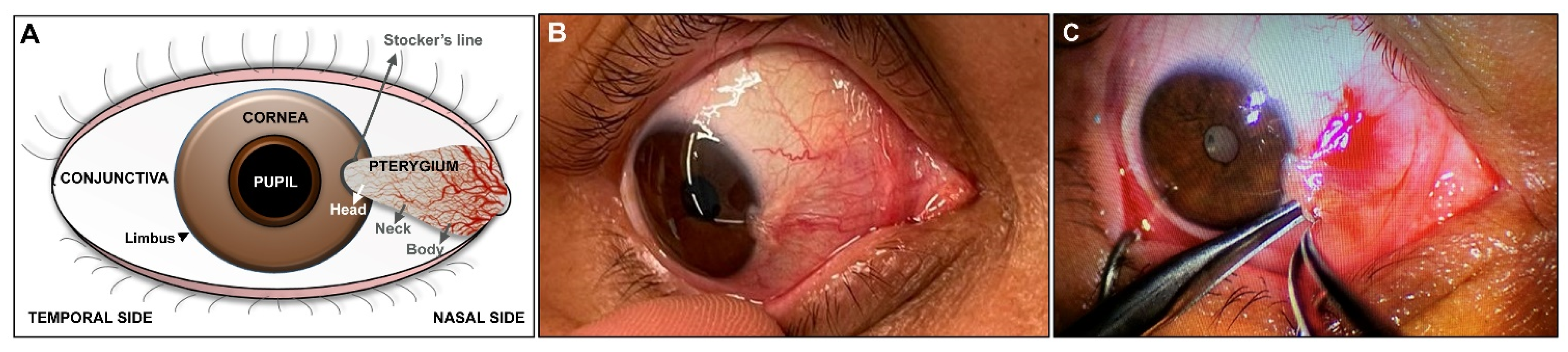 JCM | Free Full-Text | The Role of the Stromal Extracellular Matrix in the  Development of Pterygium Pathology: An Update