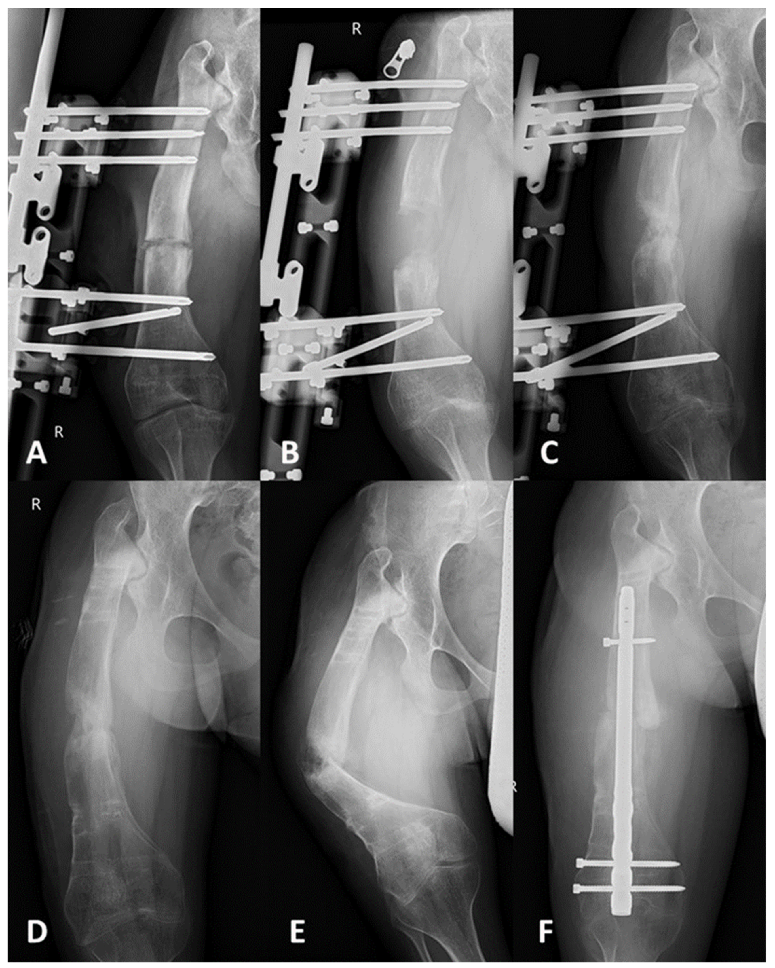 Compulsion courtesy chimney JCM | Free Full-Text | Comparison of Intramedullary Magnetic Nail,  Monolateral External Distractor, and Spatial External Fixator in Femur  Lengthening in Adolescents with Congenital Diseases | HTML