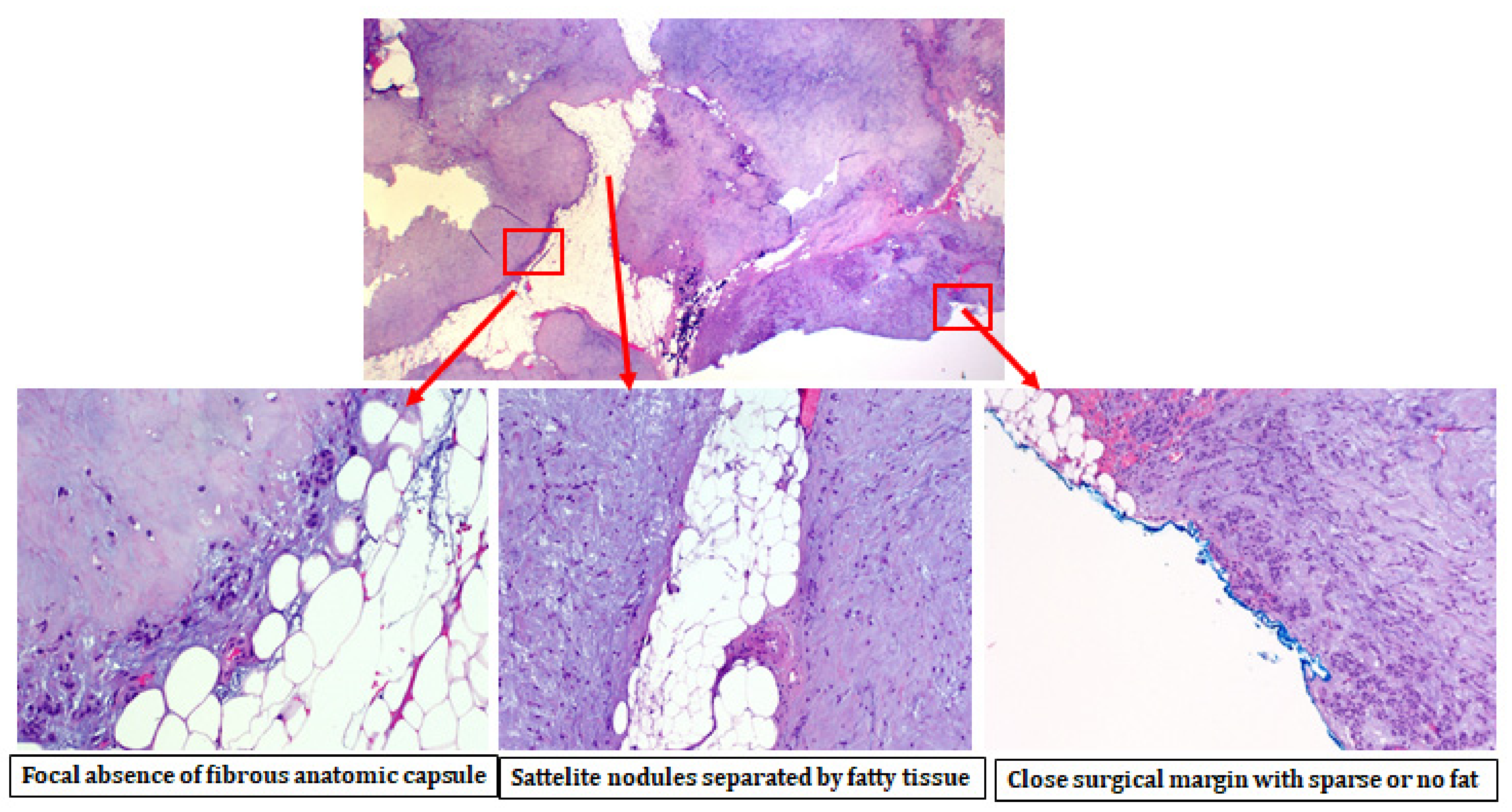 pleomorphic adenoma non surgical treatment)