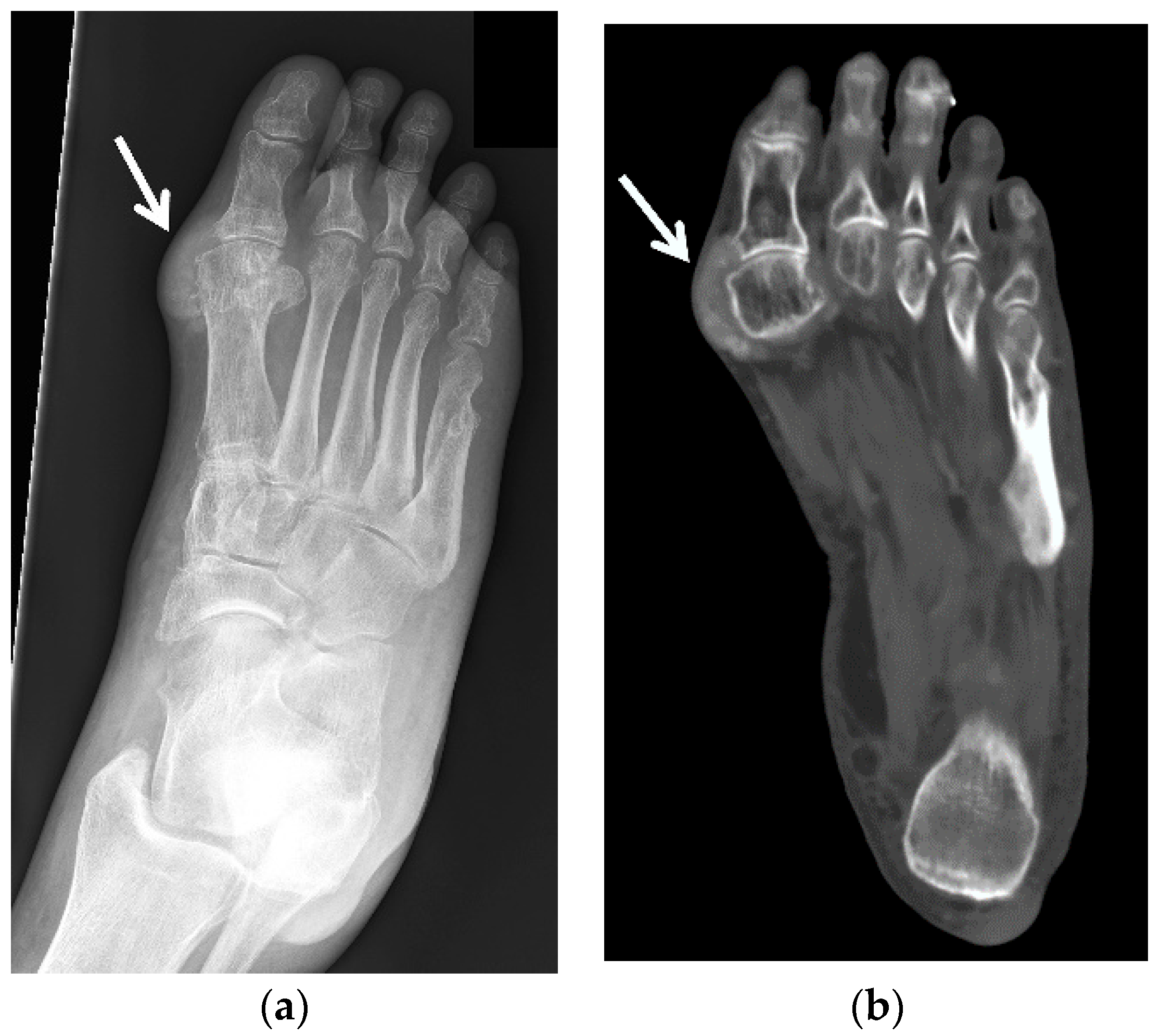 Gout ankle xray