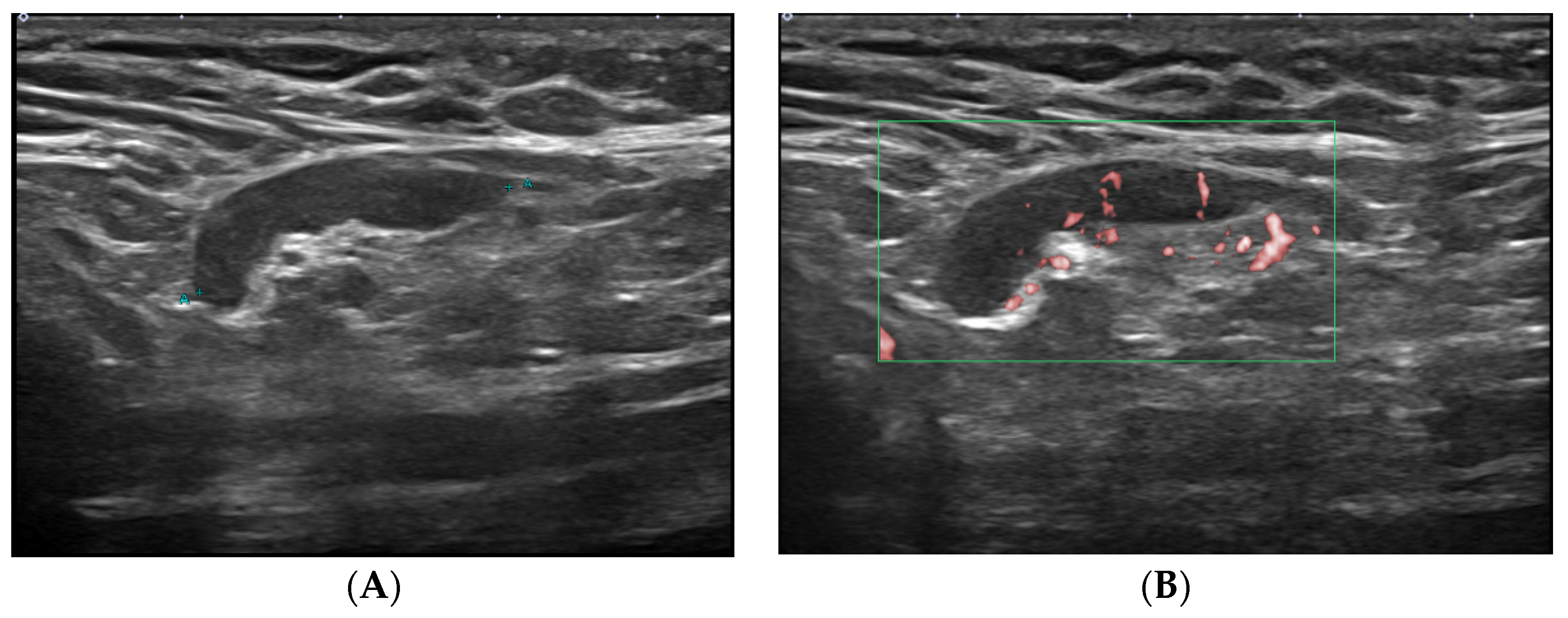 Jcm Free Full Text Axillary Lymphadenopathy On Ultrasound After