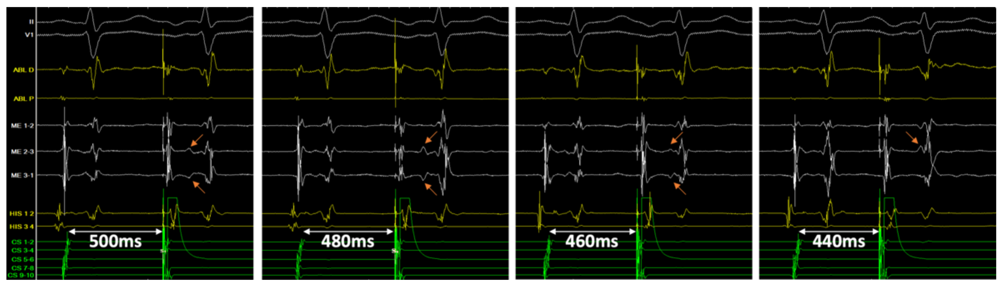 Tsuchiura's Stepwise Ablation Case Stud… PrimaLuceLab - 95mm PLUS Support Rings | PrimaluceLab USA