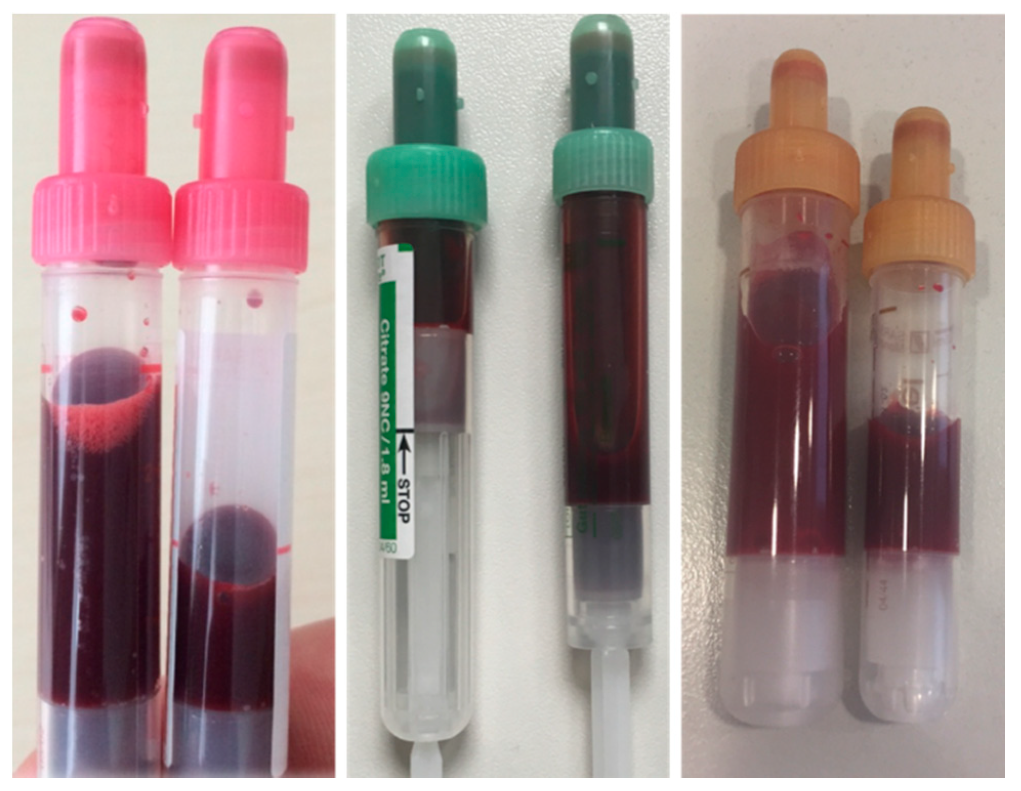 Big Blood Savings: Large Trial Shows Taking Less Blood for Lab Testing Reduces Transfusions in Intensive Care