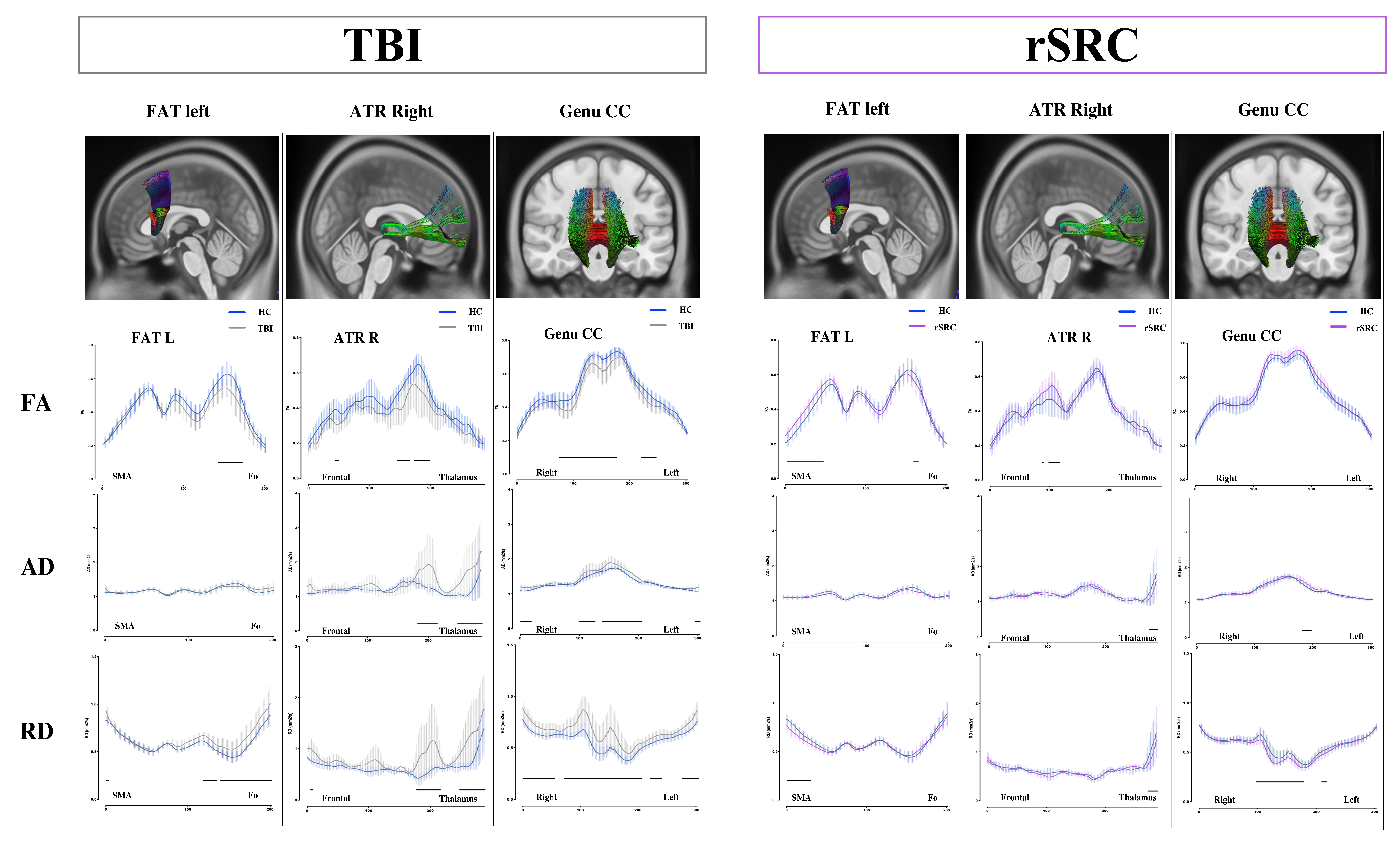 Refined Analysis of Chronic White Matter Changes after Traumatic Brain
