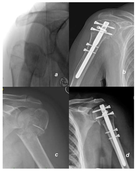 Surgical Treatment of Humeral Shaft Fractures by Arthroscopy- assisted  Intramedullary Nail Fixation