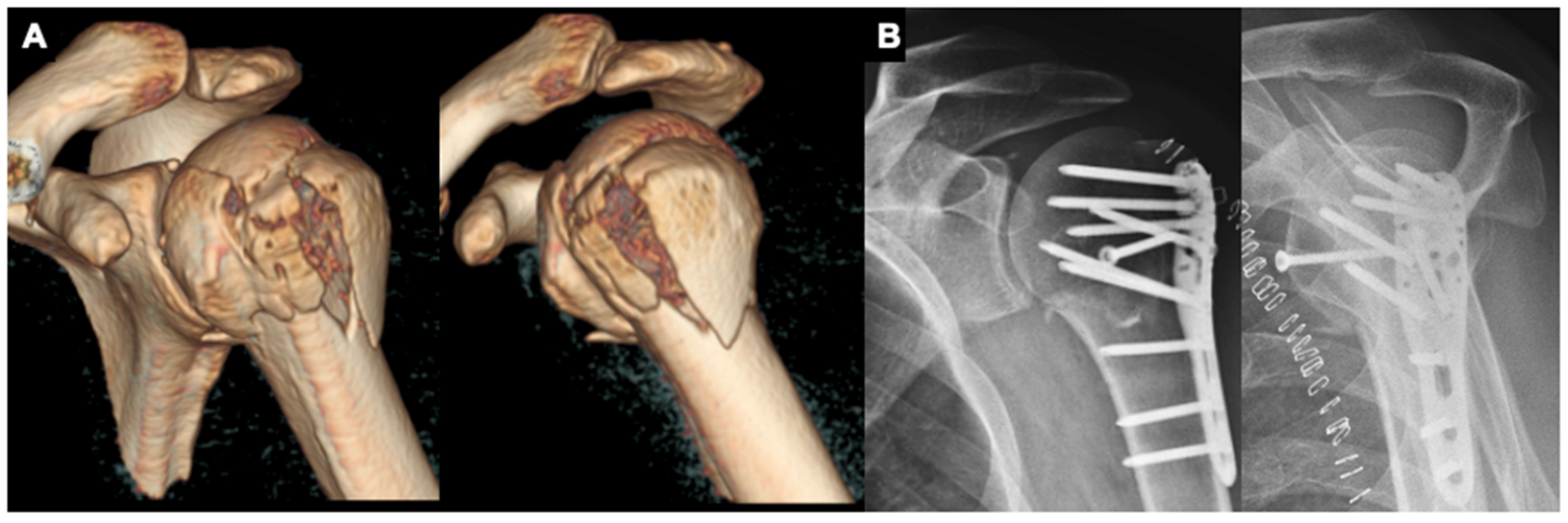 proximal humerus fracture presentation