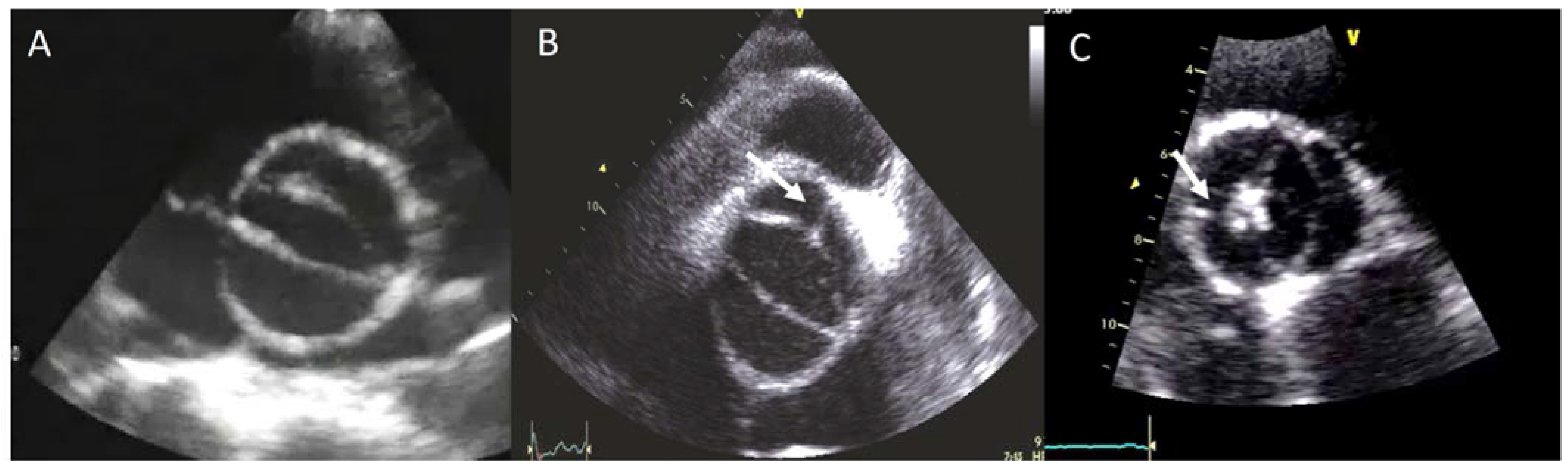 Aortic Valve Echo celiac-disease-diet-what-is-it-foods-are-eat-foods-to-avoid-and