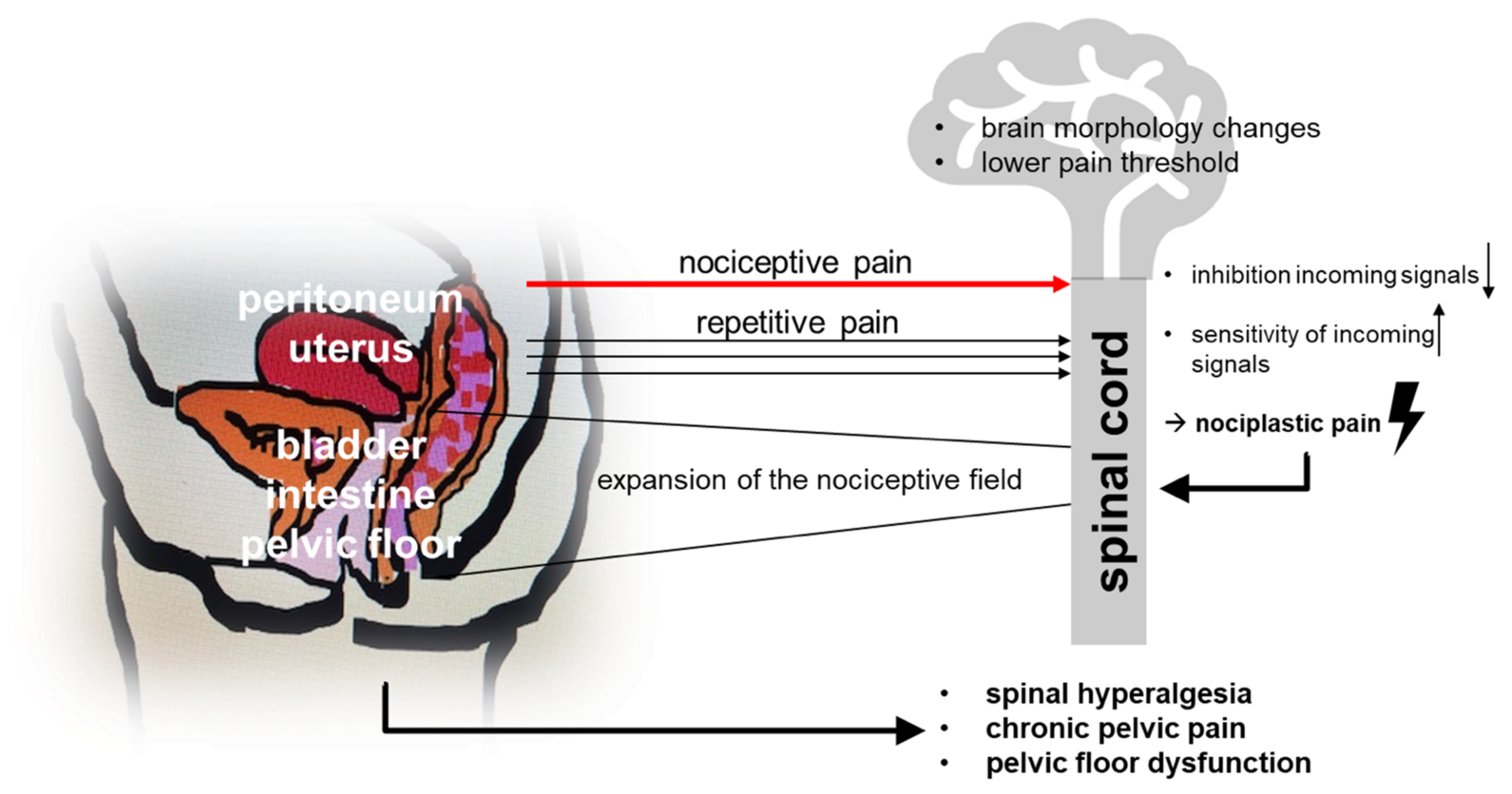 Jcm Free Full Text Endometriosis