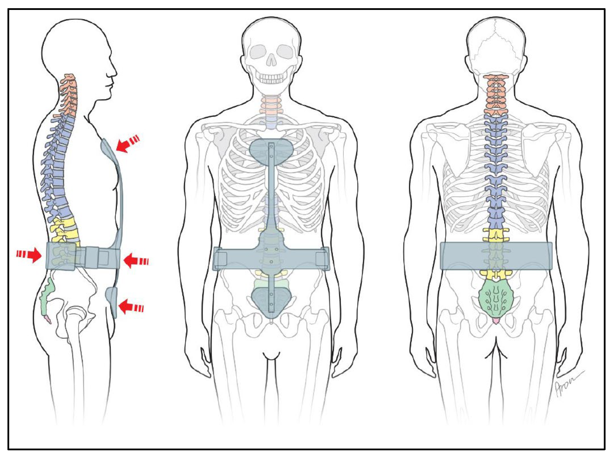 JCM Free FullText An IndicationBased Concept for Stepwise Spinal