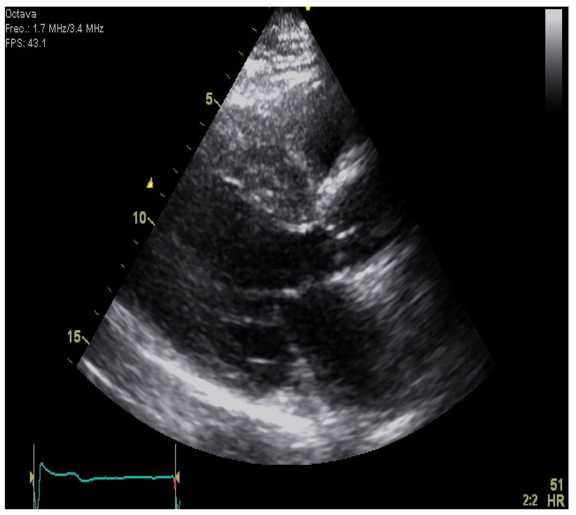 Apical Sparing of Longitudinal Strain, Left Ventricular Rotational  Abnormalities, and Short-Axis Dysfunctionin Primary Hyperoxaluria Type 1