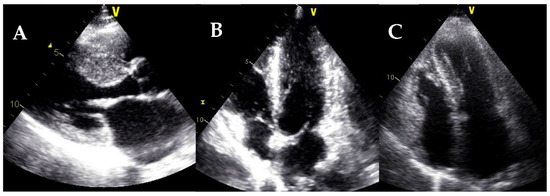 Apical Sparing of Longitudinal Strain, Left Ventricular Rotational  Abnormalities, and Short-Axis Dysfunctionin Primary Hyperoxaluria Type 1