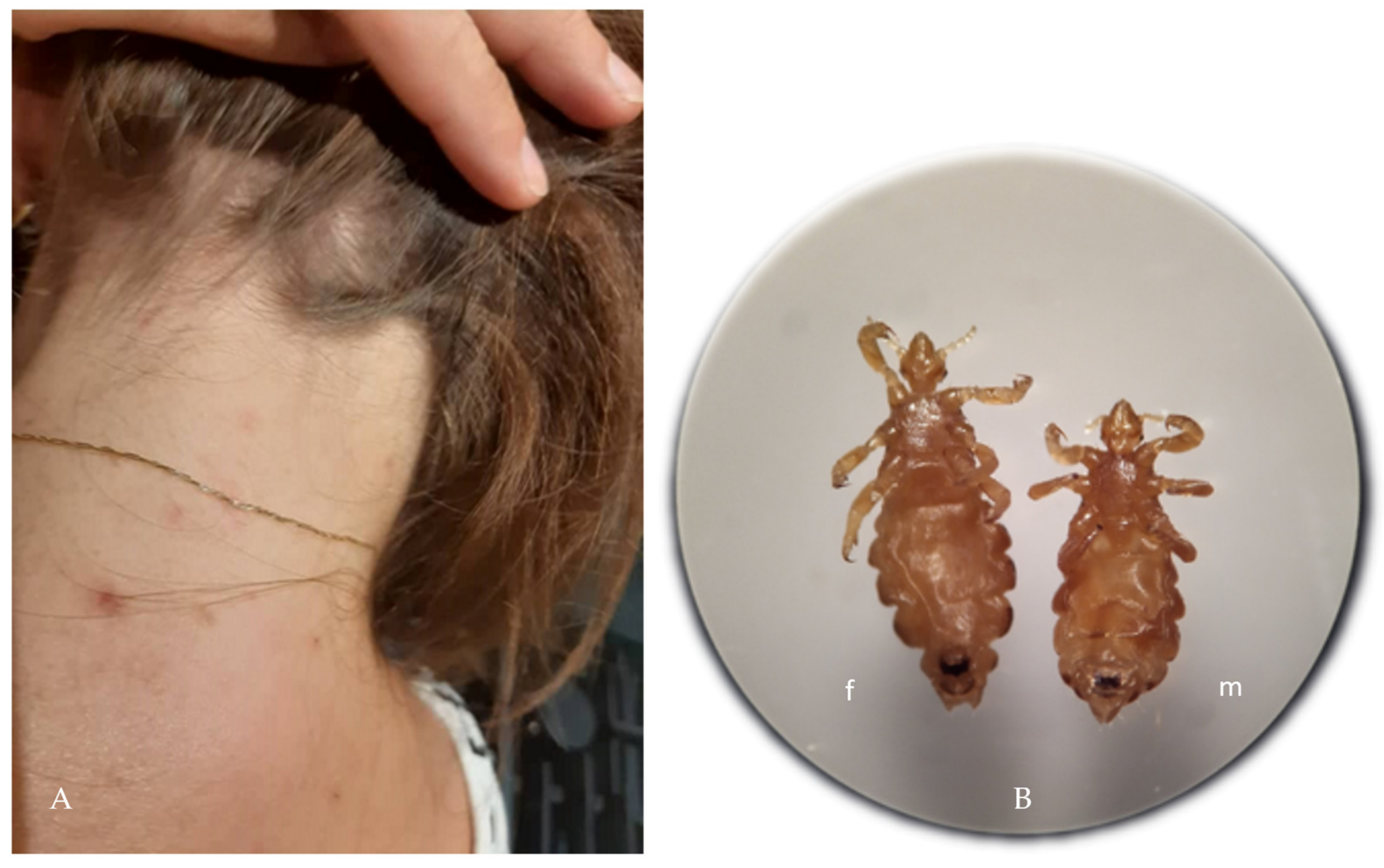 JCM | Free Full-Text | Head Lice Infestation in Schoolchildren, in  Poland—Is There a Chance for Change?