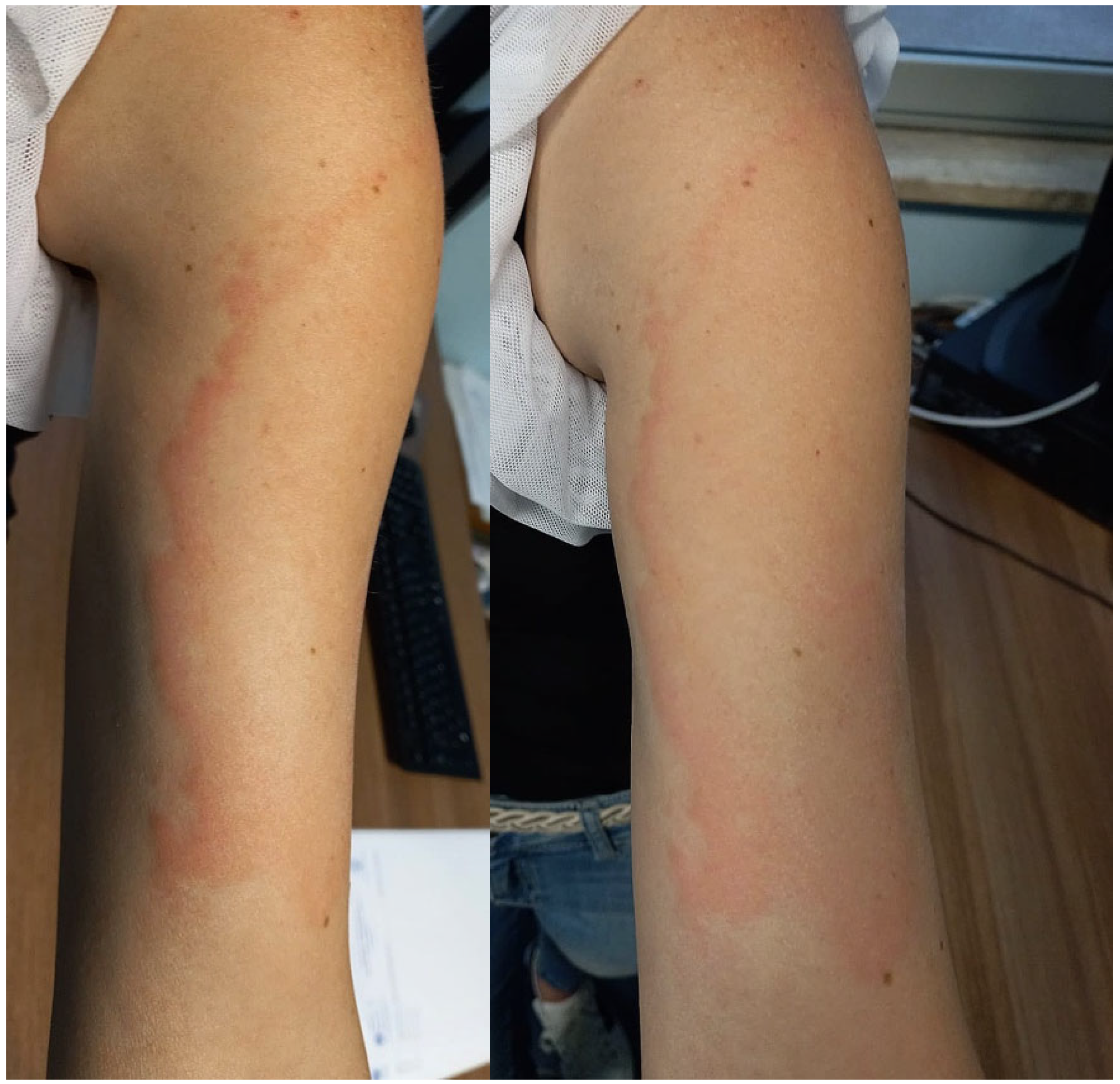 JCM Free FullText Erythema Migranslike COVID Vaccine Arm A