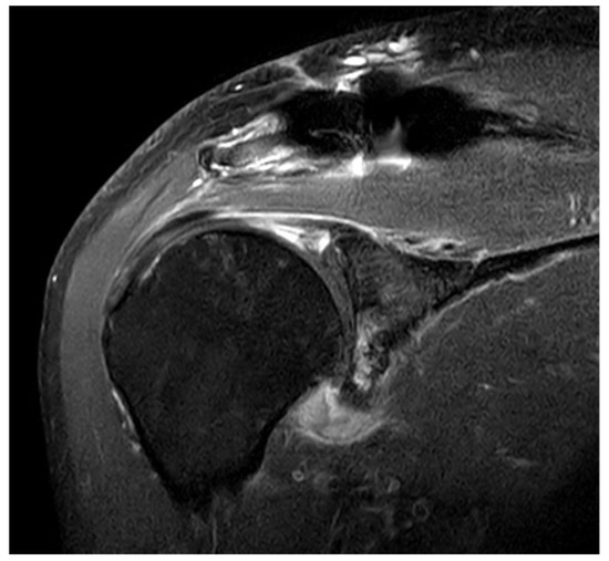 Complications and Frequency of Surgical Treatment with AO-Type 