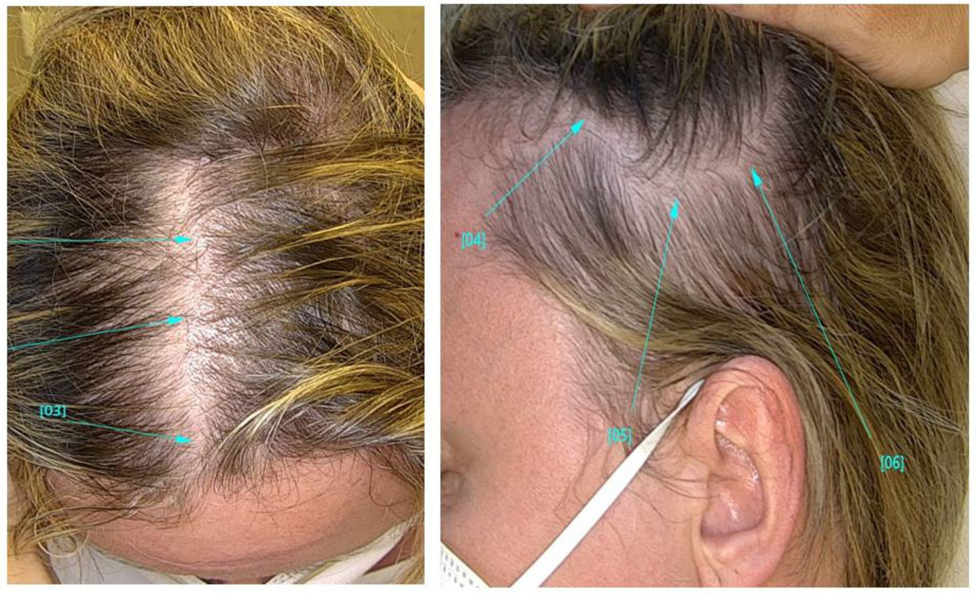 Telogen hair discount