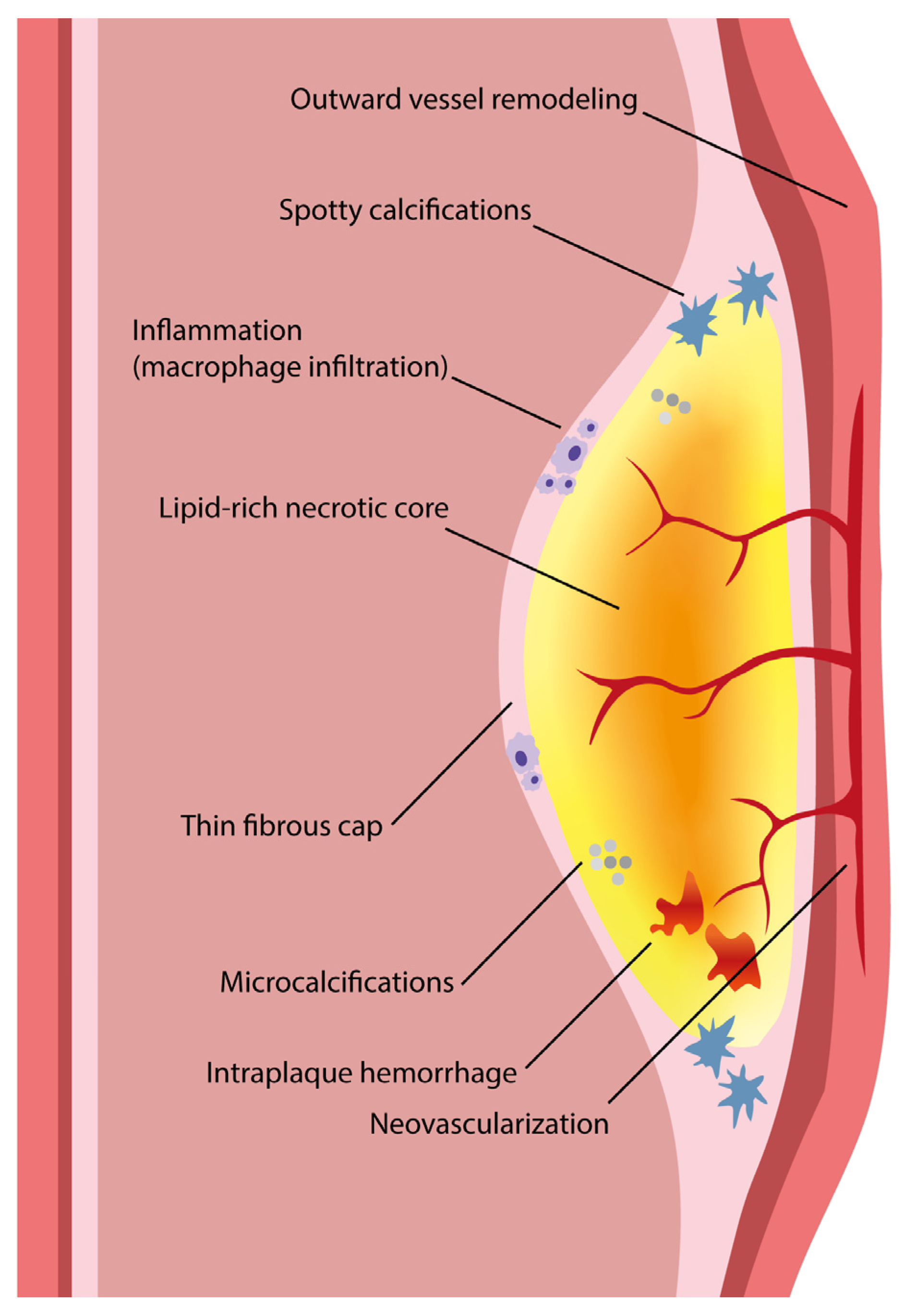 Primary Tumors of the Small Intestine