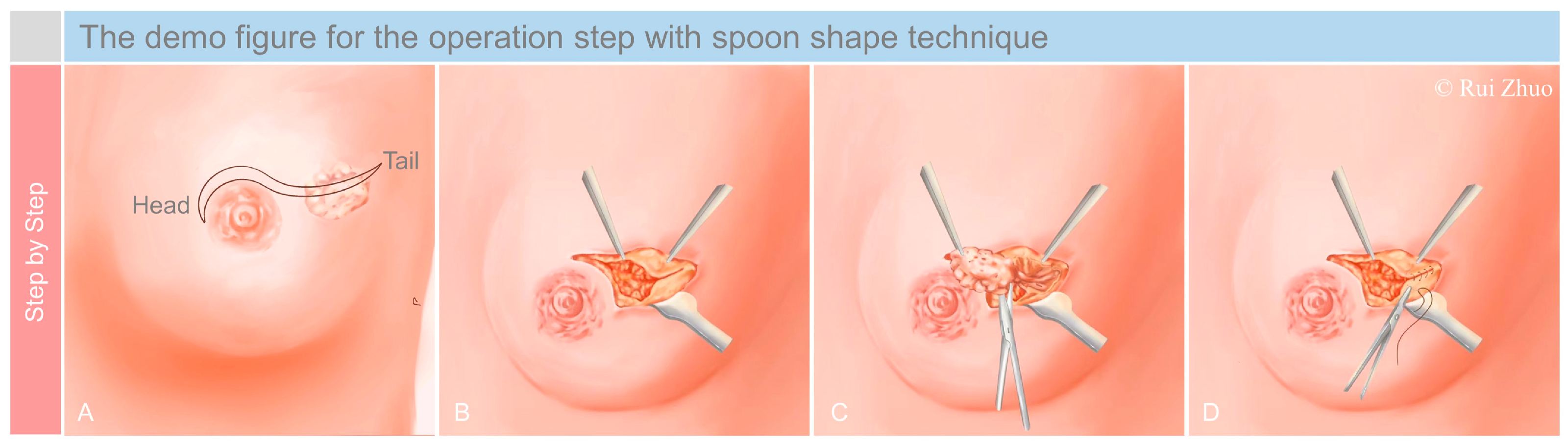 JCM | Free Full-Text | An Innovative Minimally Invasive