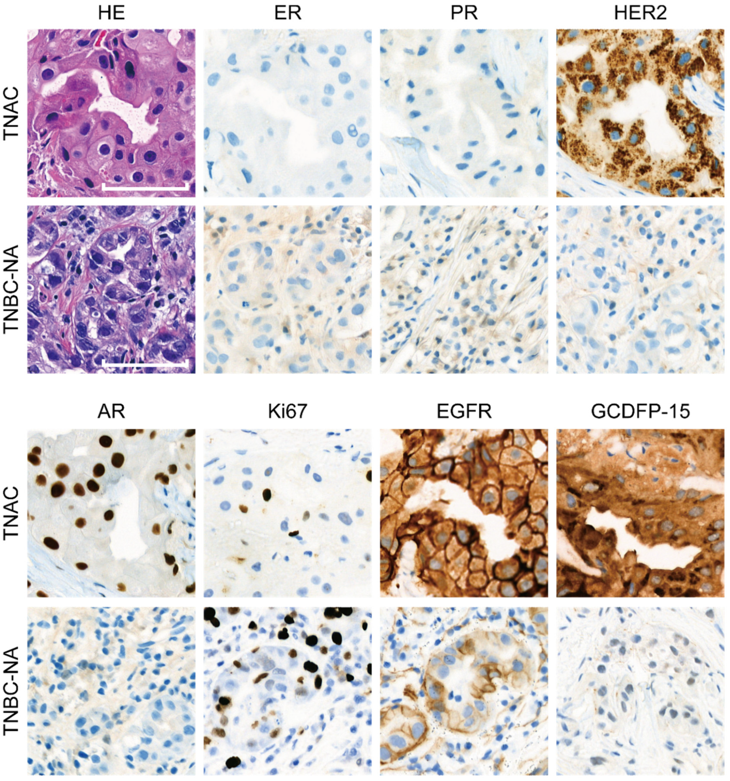 健康・医学 Preneoplasia of the Breast Triple-Negative Apocrine Breast Carcinoma Has Better